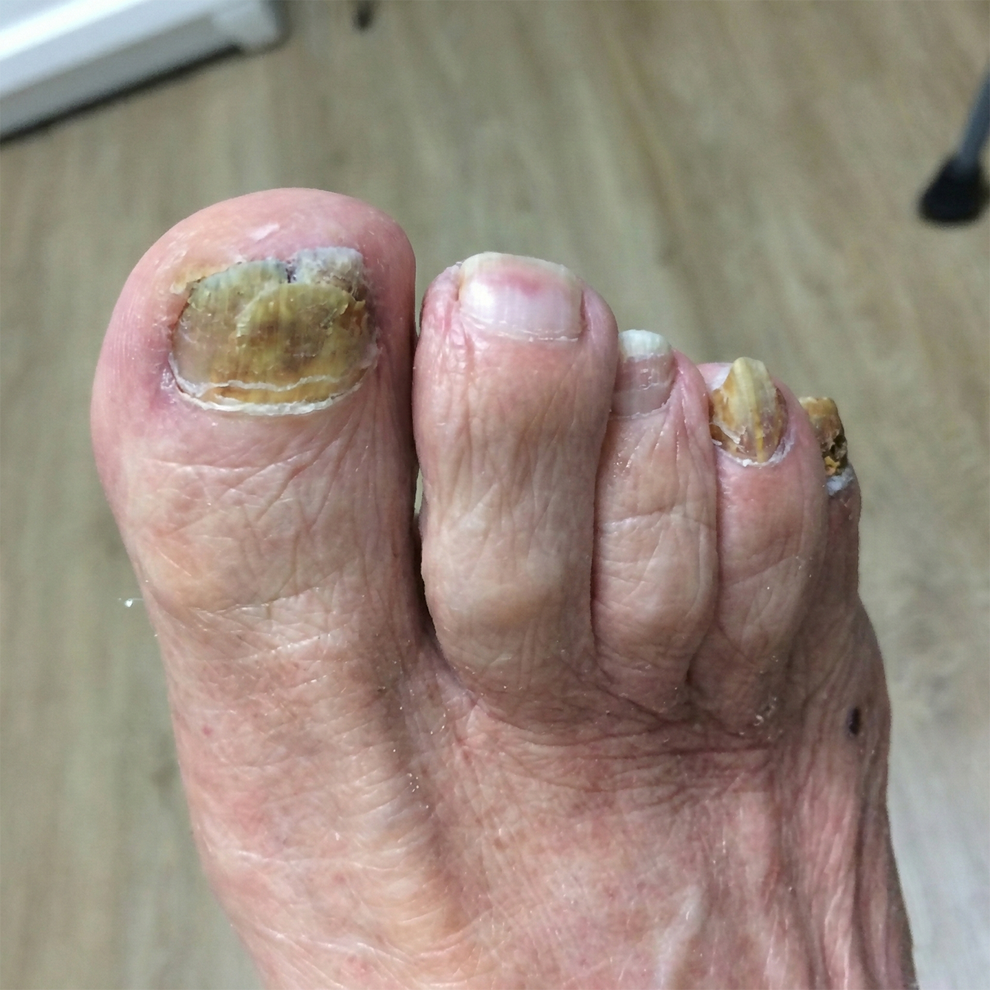 Noyra Facebook ad: Endlich frei von Nagelpilz.
