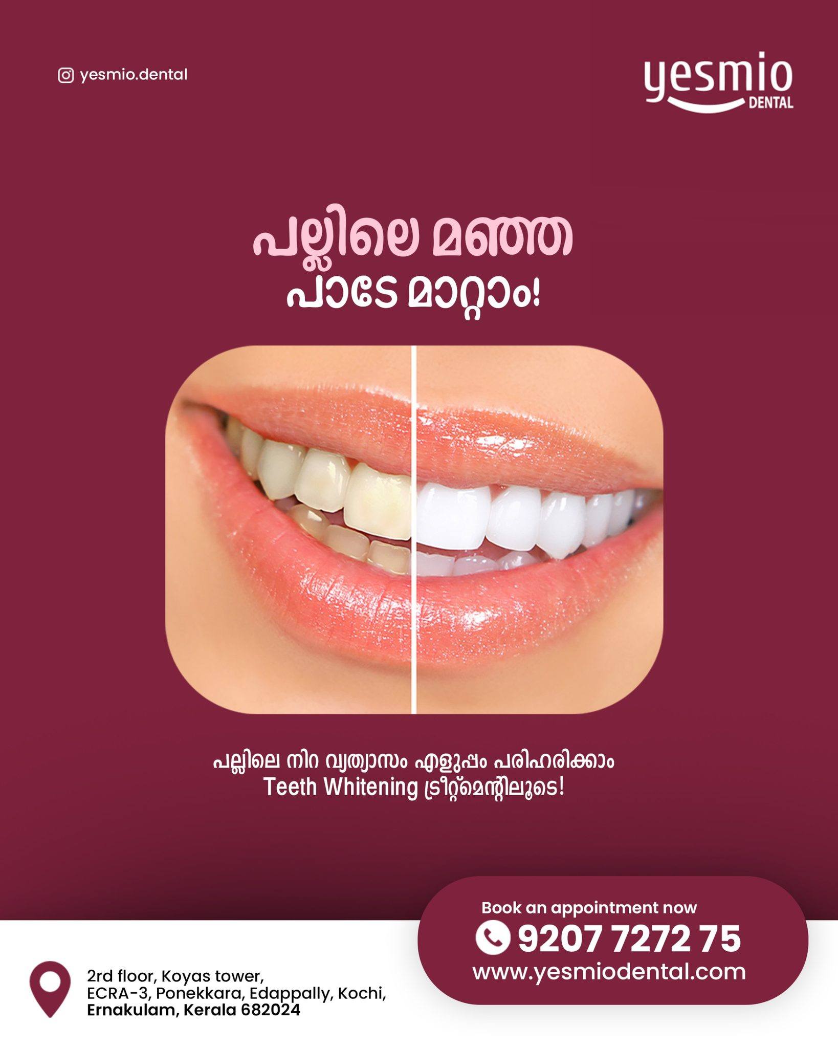 Yesmio Dental Facebook ad: Stains on your teeth holding you back from…