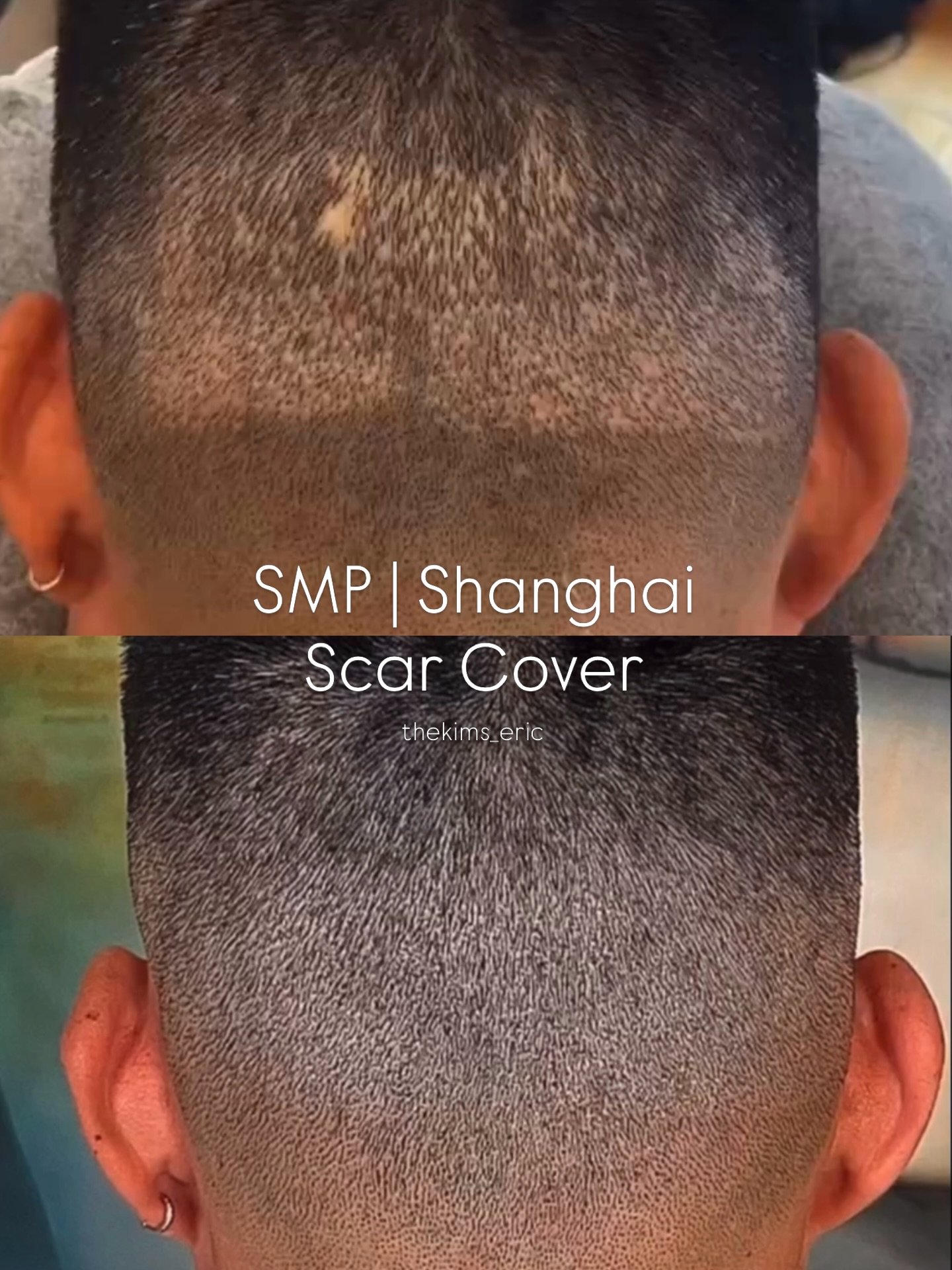 thekims_eric Facebook ad: Scalp Micropigmentation | Shanghai