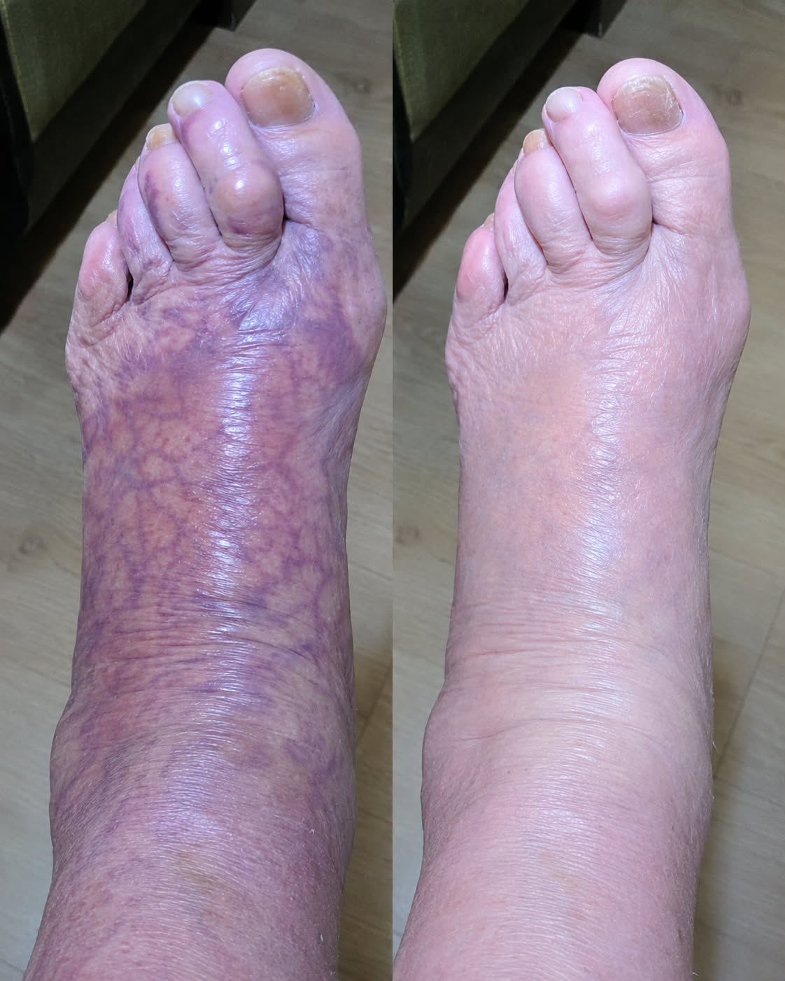 Burning & Tingling Feet Community Facebook ad: Feel finally free, from your pain