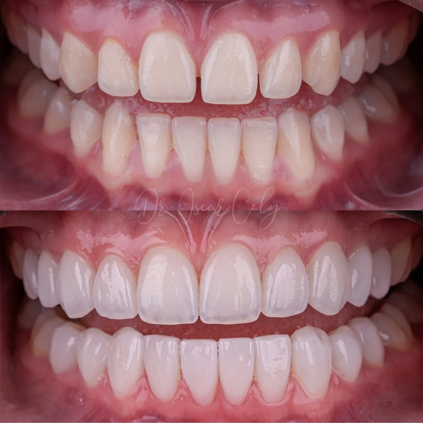 Dr. Oscar Cely unidad robótica dental 3d Facebook ad: Diseño de sonrisa en lentes cerámicos con traslúcidos…