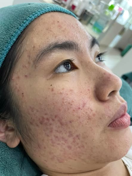 JBeauty Skin Center Facebook ad: DON'T WASTE MONEY ON ACNE TREATMENT PRODUCTS ONLINE