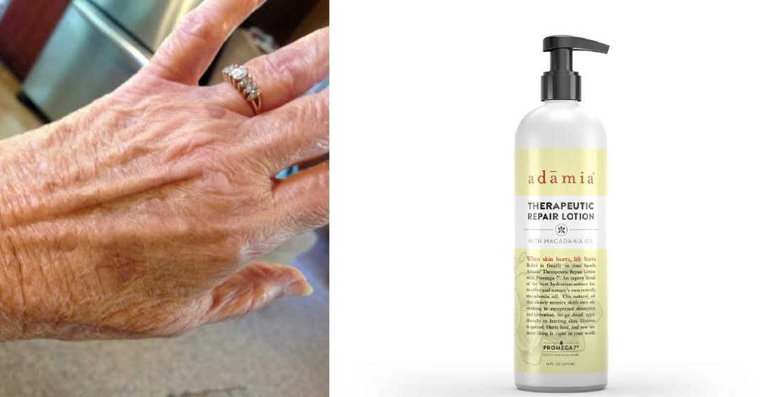 Adamia Therapeutic Repair Lotion Facebook ad: My skin tears easily thanks to blood thinners…