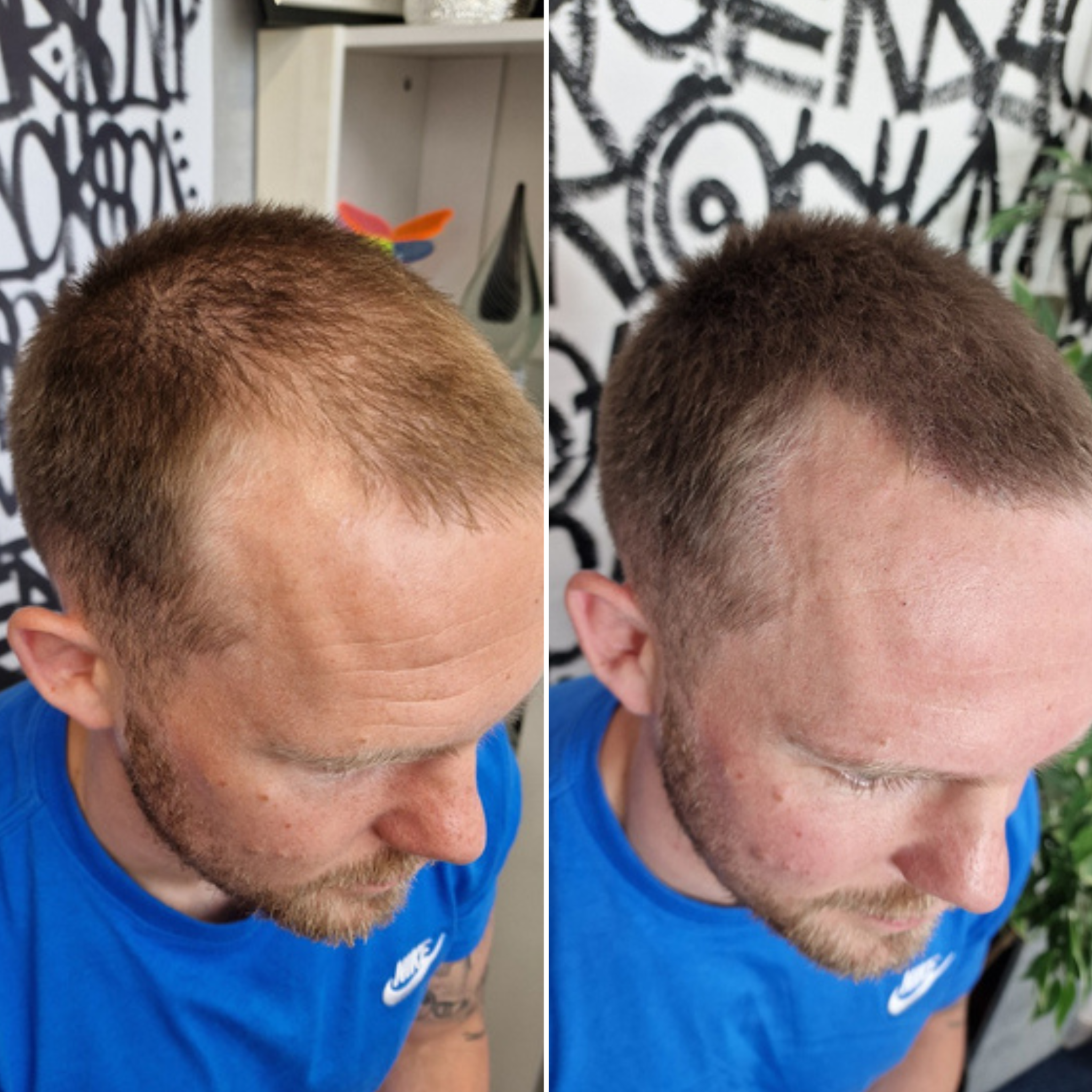 Scalp Micro UK Facebook ad: I got this done and it fixed my…