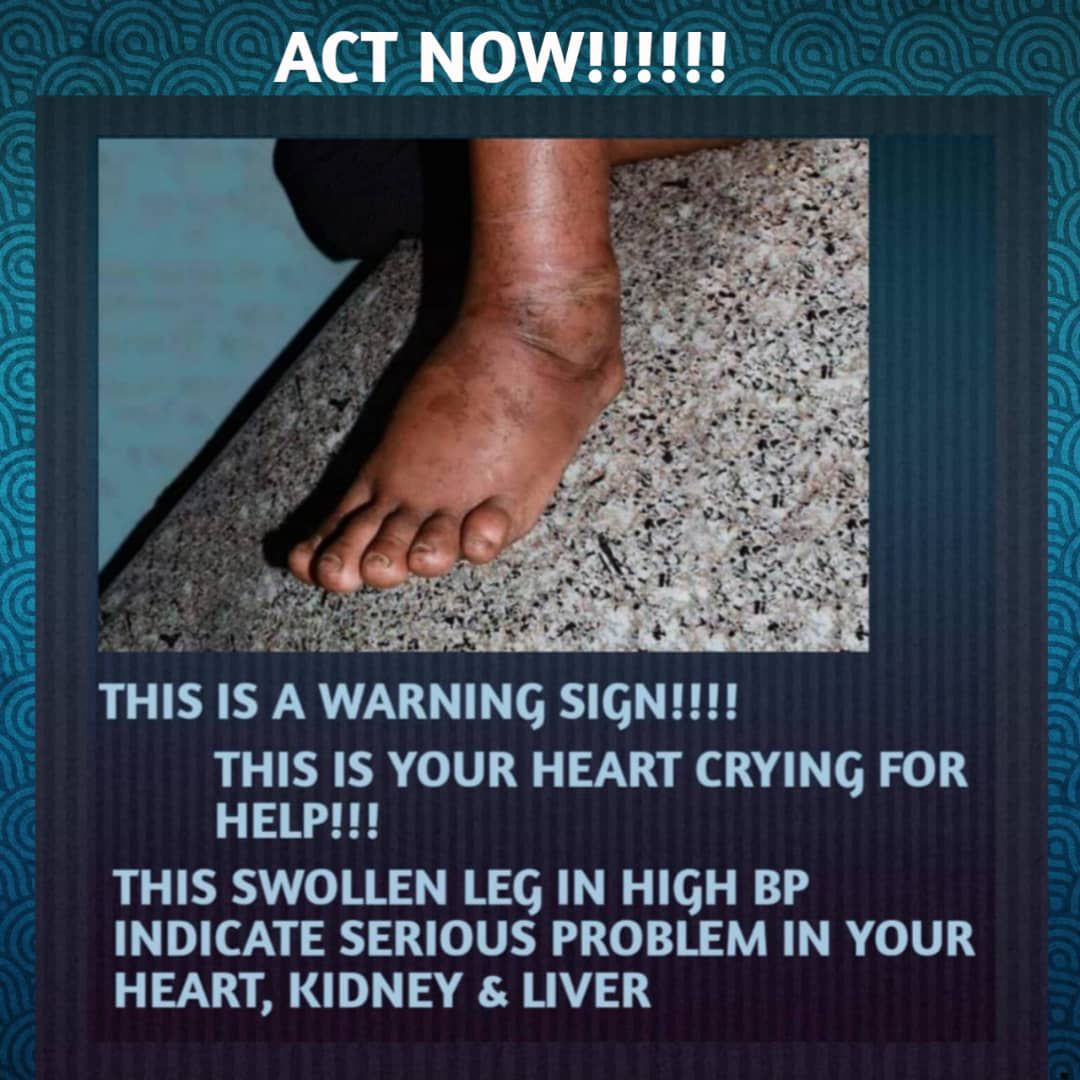 High Blood pressure Remedy Facebook ad: Leg Swelling? Dizziness? You Could Be at Risk, Act Now…