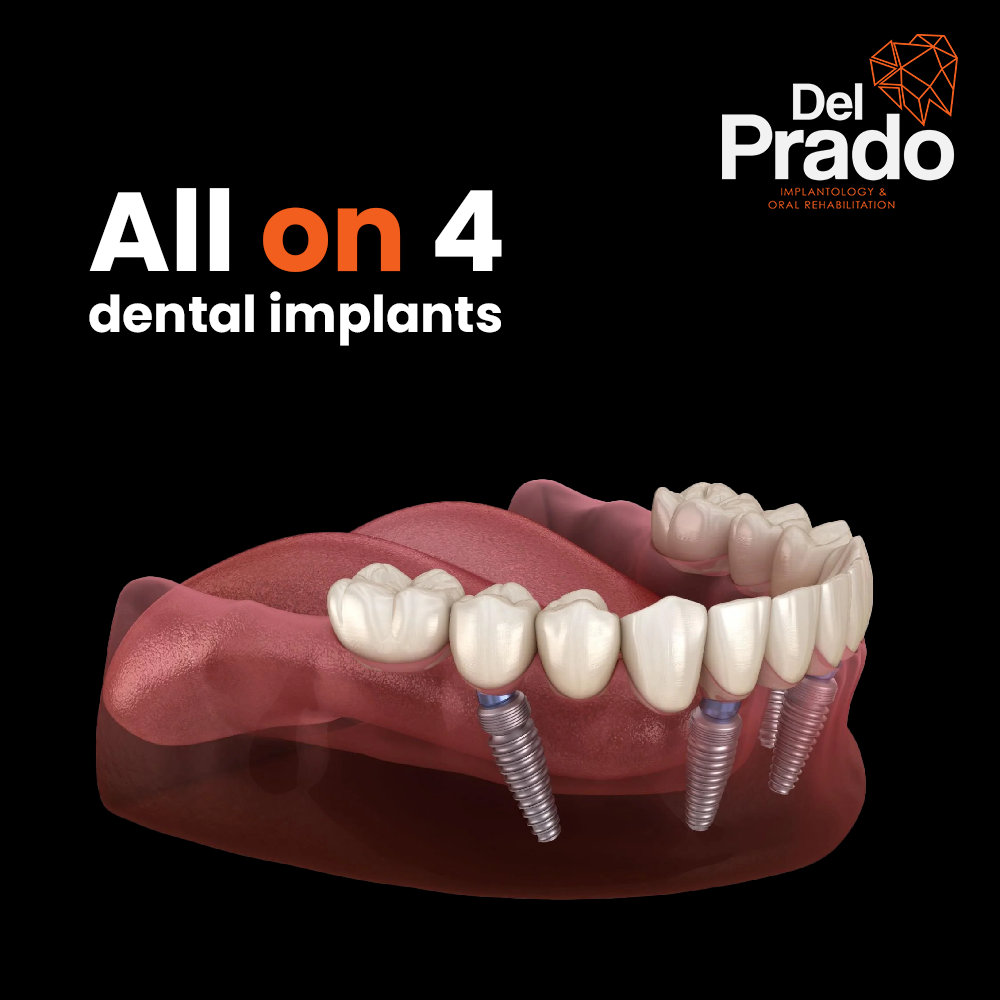 Del Prado Implants Facebook ad