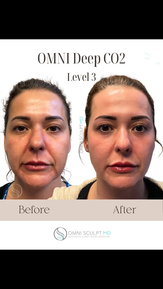 OmniSculptMD Facebook ad: $100 off for New Patients