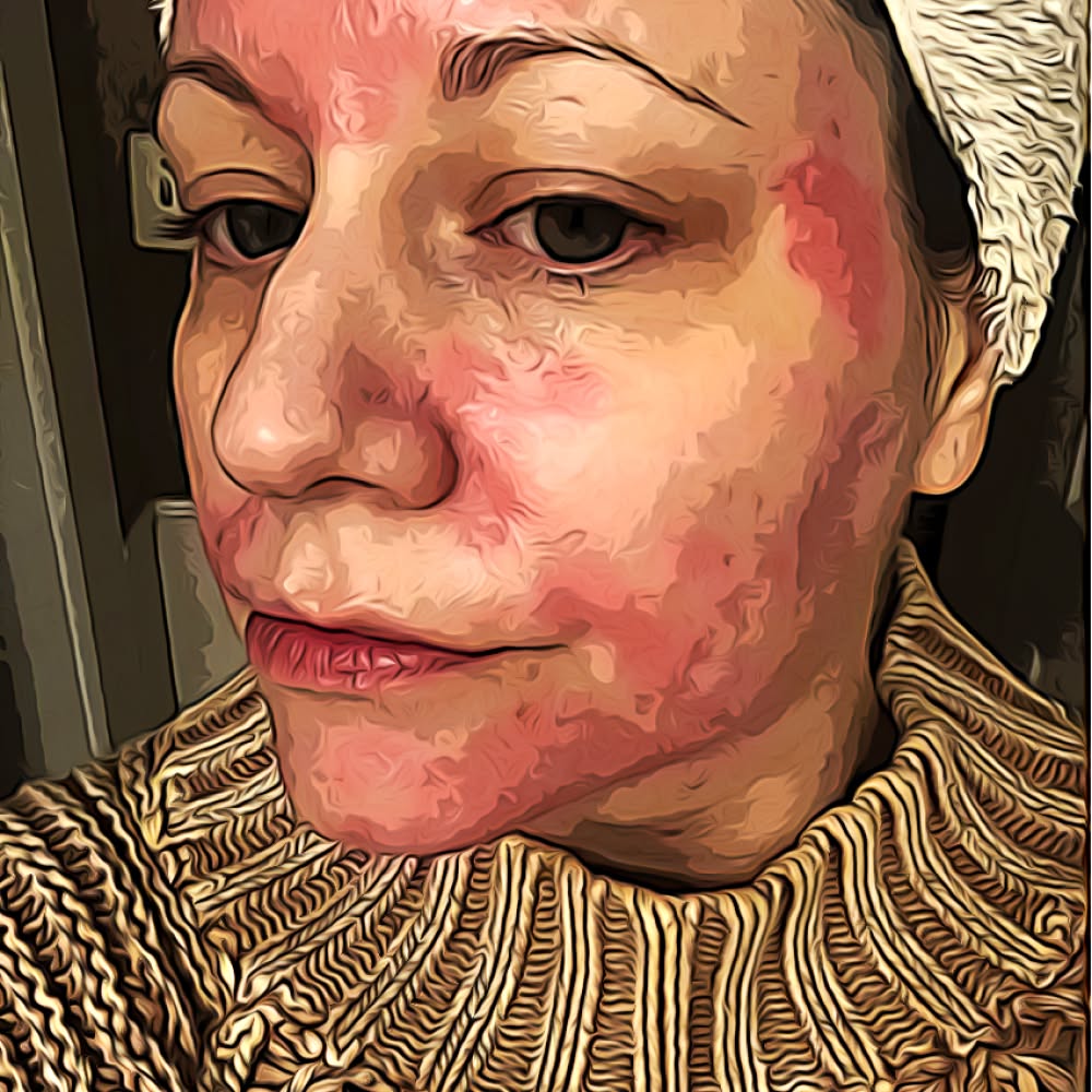 Eczema & Psoriasis Blog Facebook ad