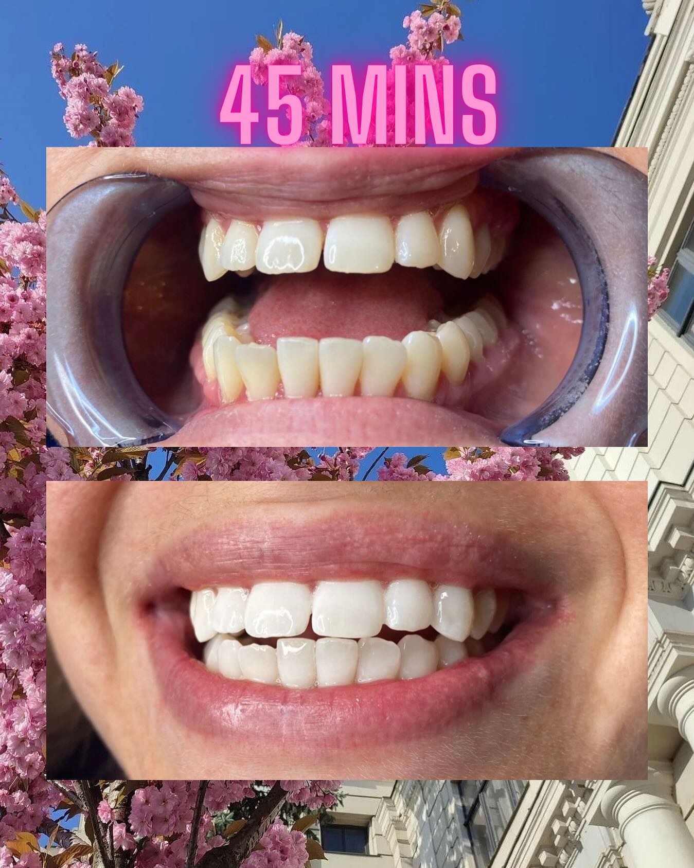 toothplugcanada Facebook ad: 45 mins
