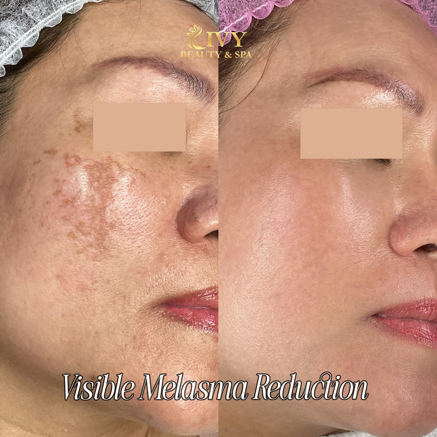 Ivy Beauty And Spa - ScarBorough Facebook ad: From stubborn melasma & hyperpigmentation to acne scars…