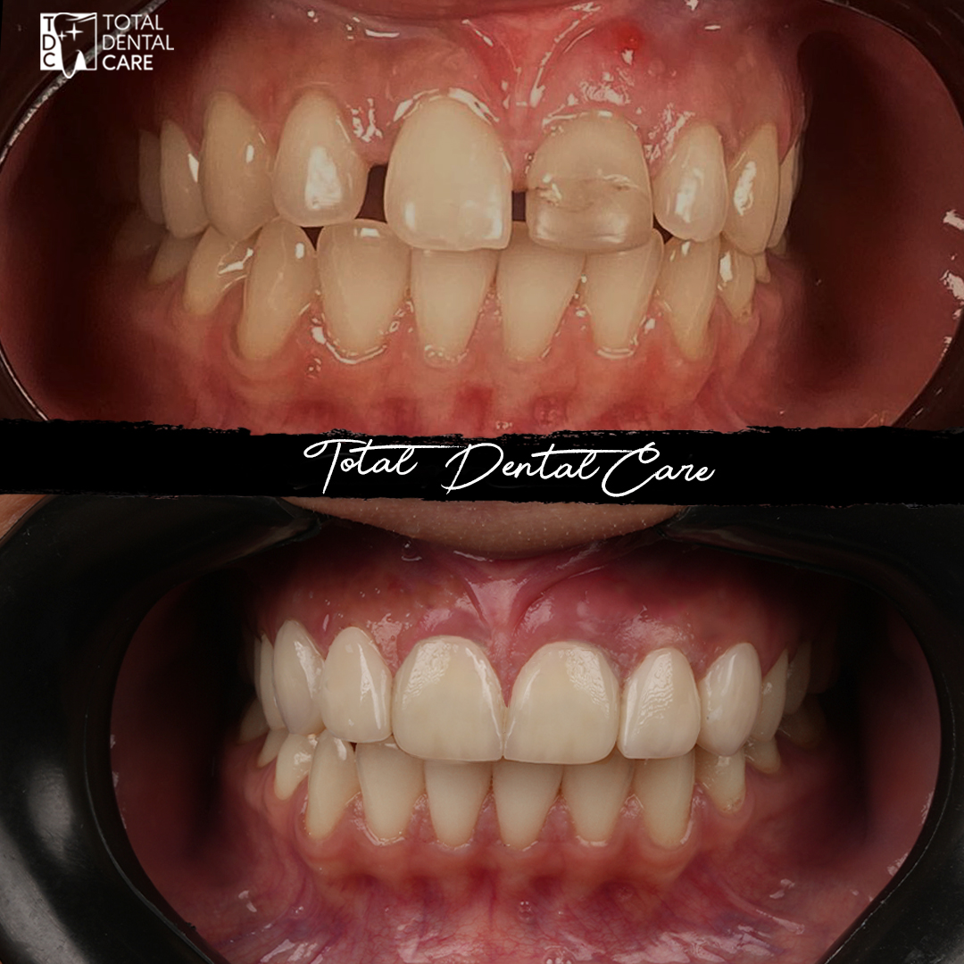 Total Dental Care توتال كير للاسنان Facebook ad: الفرق كبير جداً بين قبل و بعد وكل…