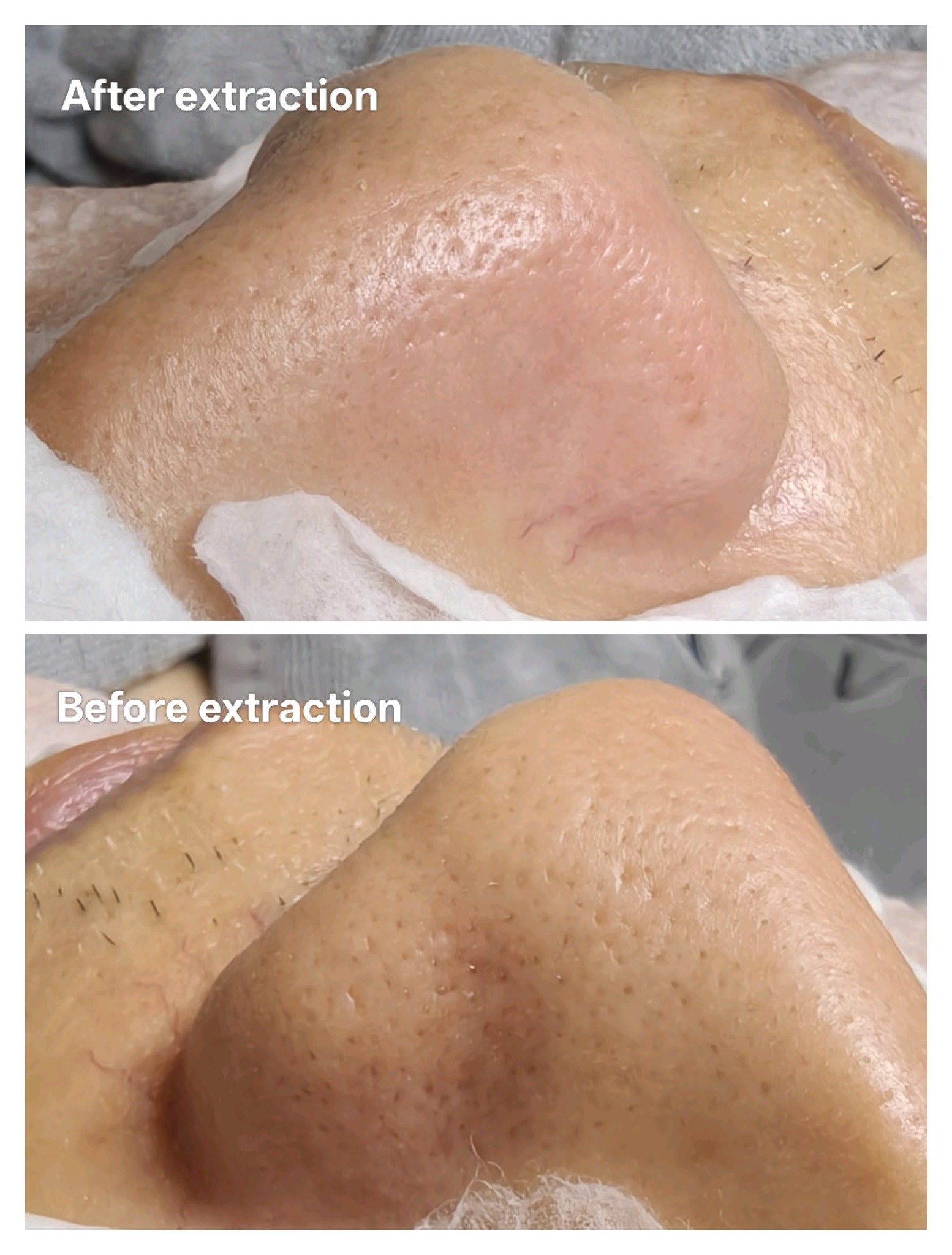 Geranium Facebook ad: Extractions Doesn't Have To Hurt. Try Painless Facial Today.