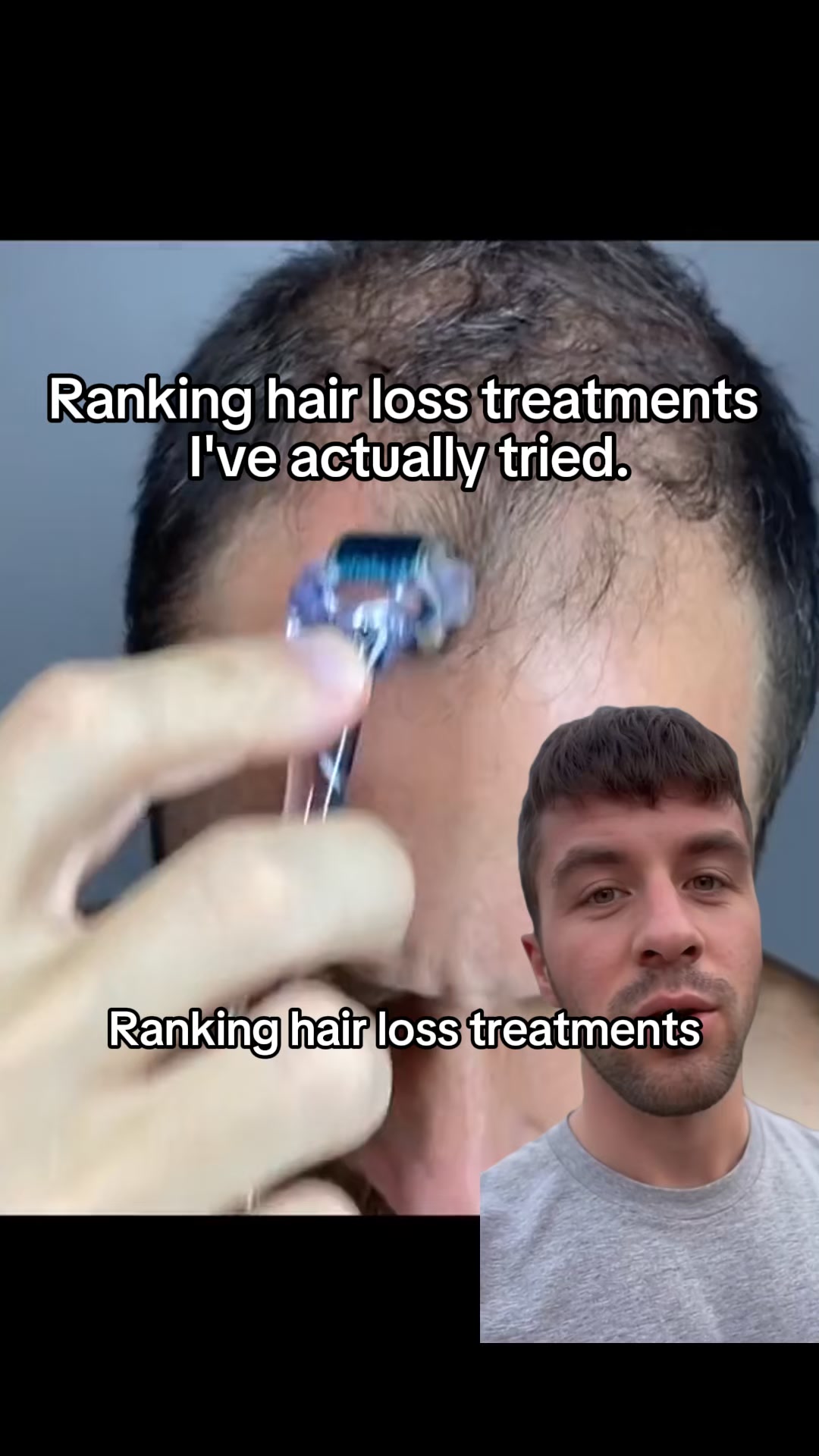 Alex Lombardy Hair Expert Facebook ad: Reverse Hair Loss (Without Drugs or Side Effects)
