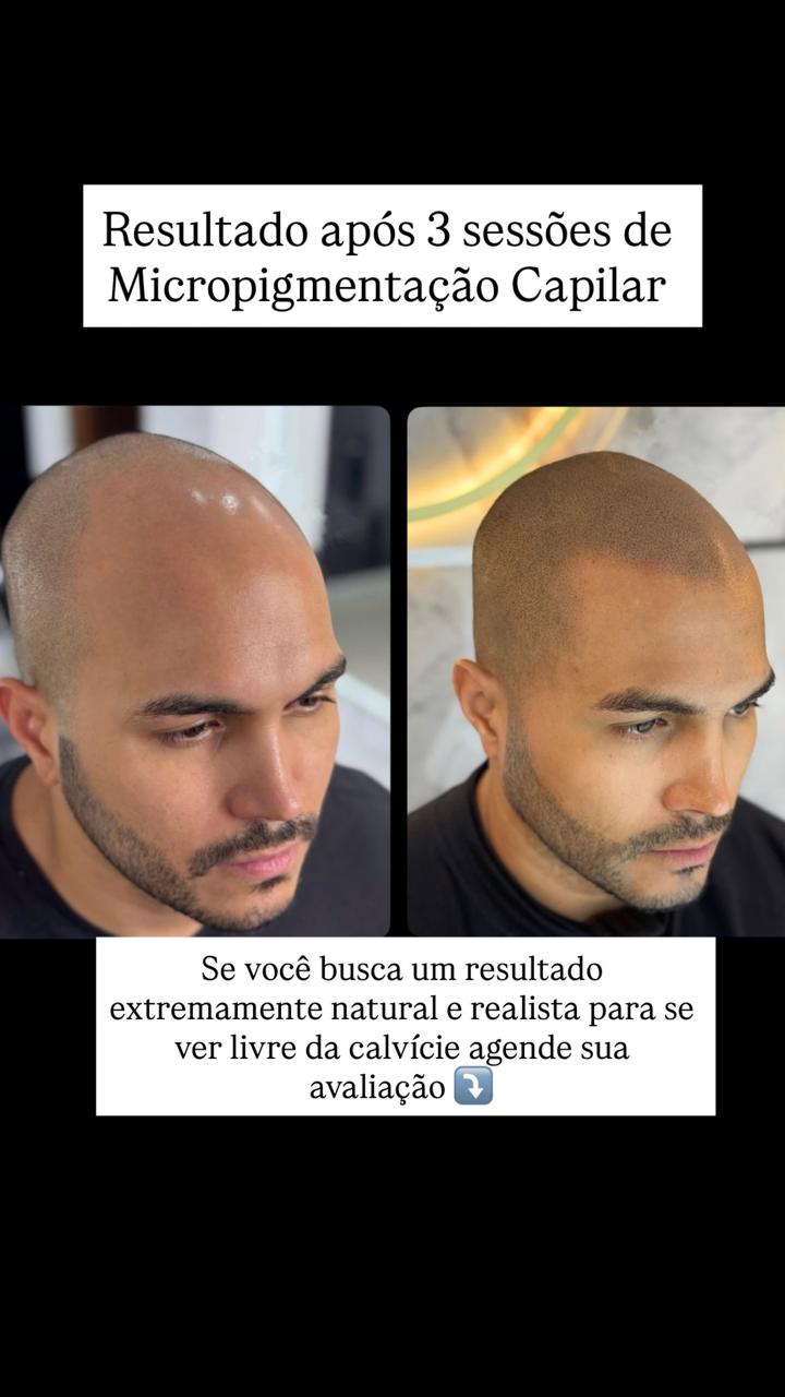Gessika Nogueira Clinic Facebook ad: A Micropigmentação Capilar é a solução ideal para…
