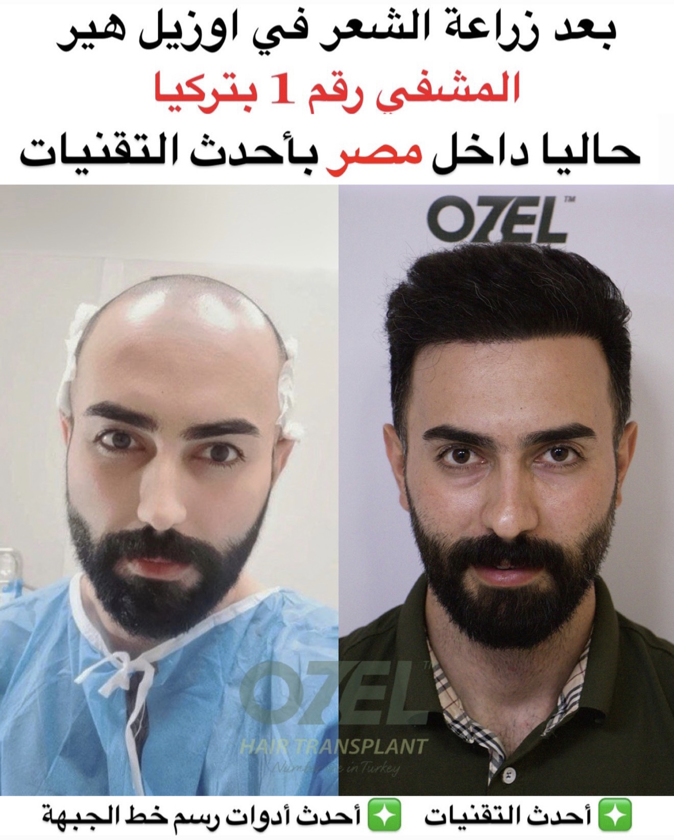 Ozel Hair Transplant Facebook ad: احجز استشارتك الآن