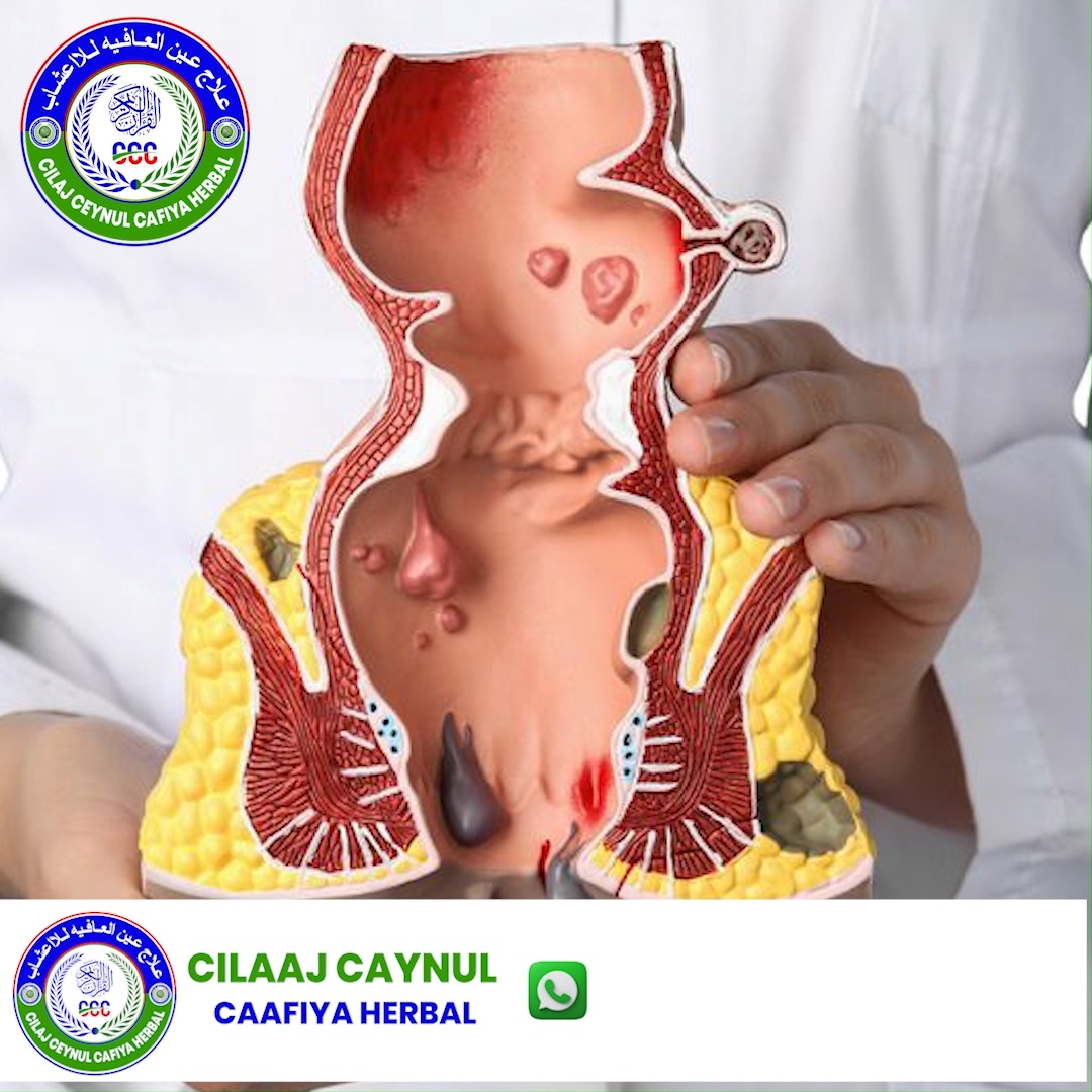 Cilaajka Ceynul -Caafiya Facebook ad