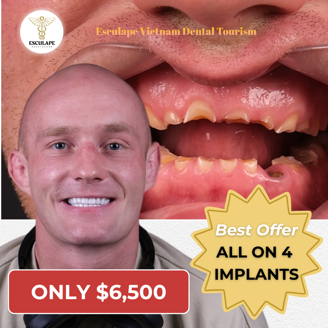 Esculape - Vietnam Dental Tourism Facebook ad: GET YOUR FULL COST BREAKDOWN