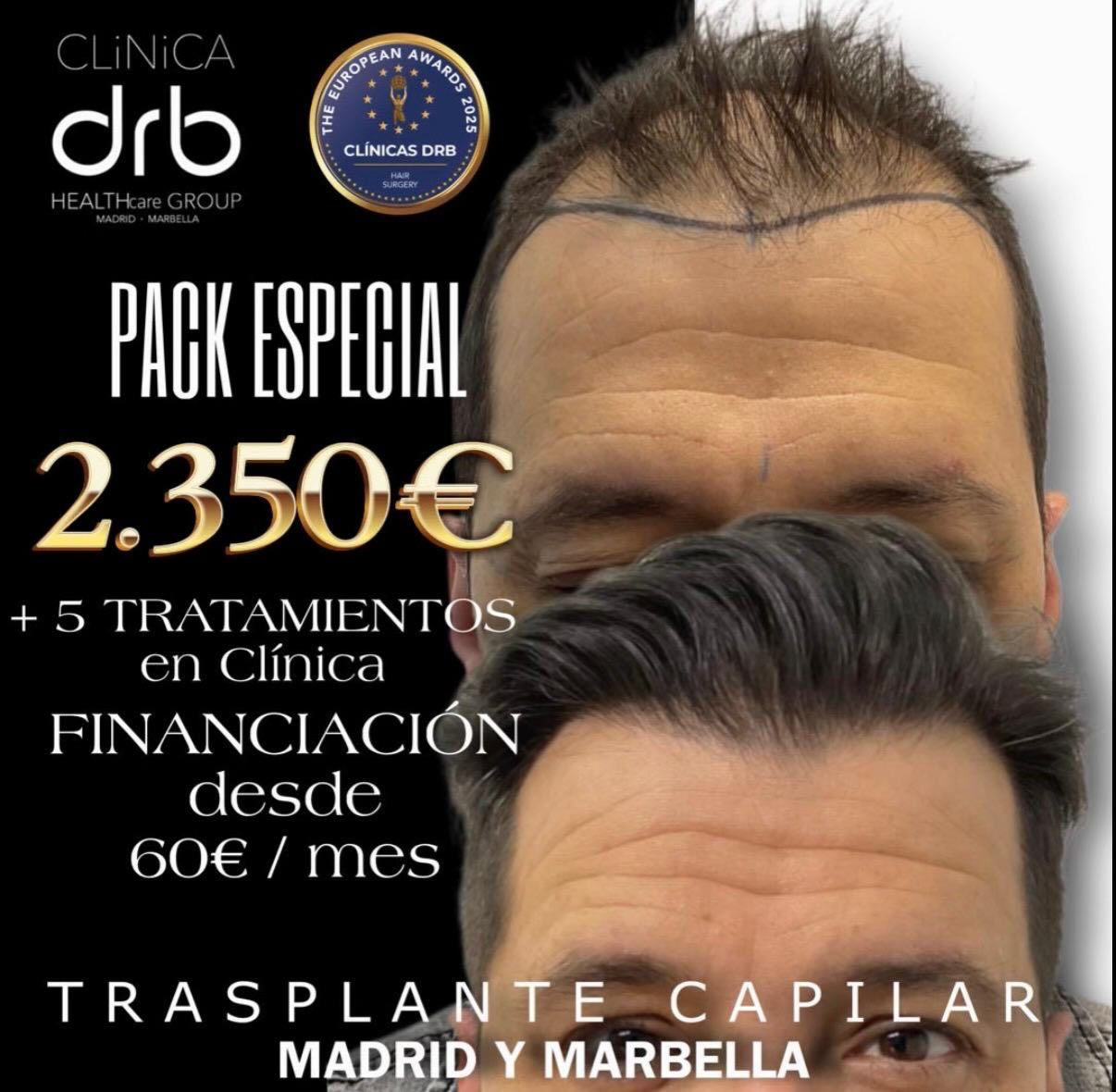 Cirugiacapilar.es Facebook ad: PAQUETE MARZO CIRUGIA CAPILAR 2.350€* GANADORES DEL…