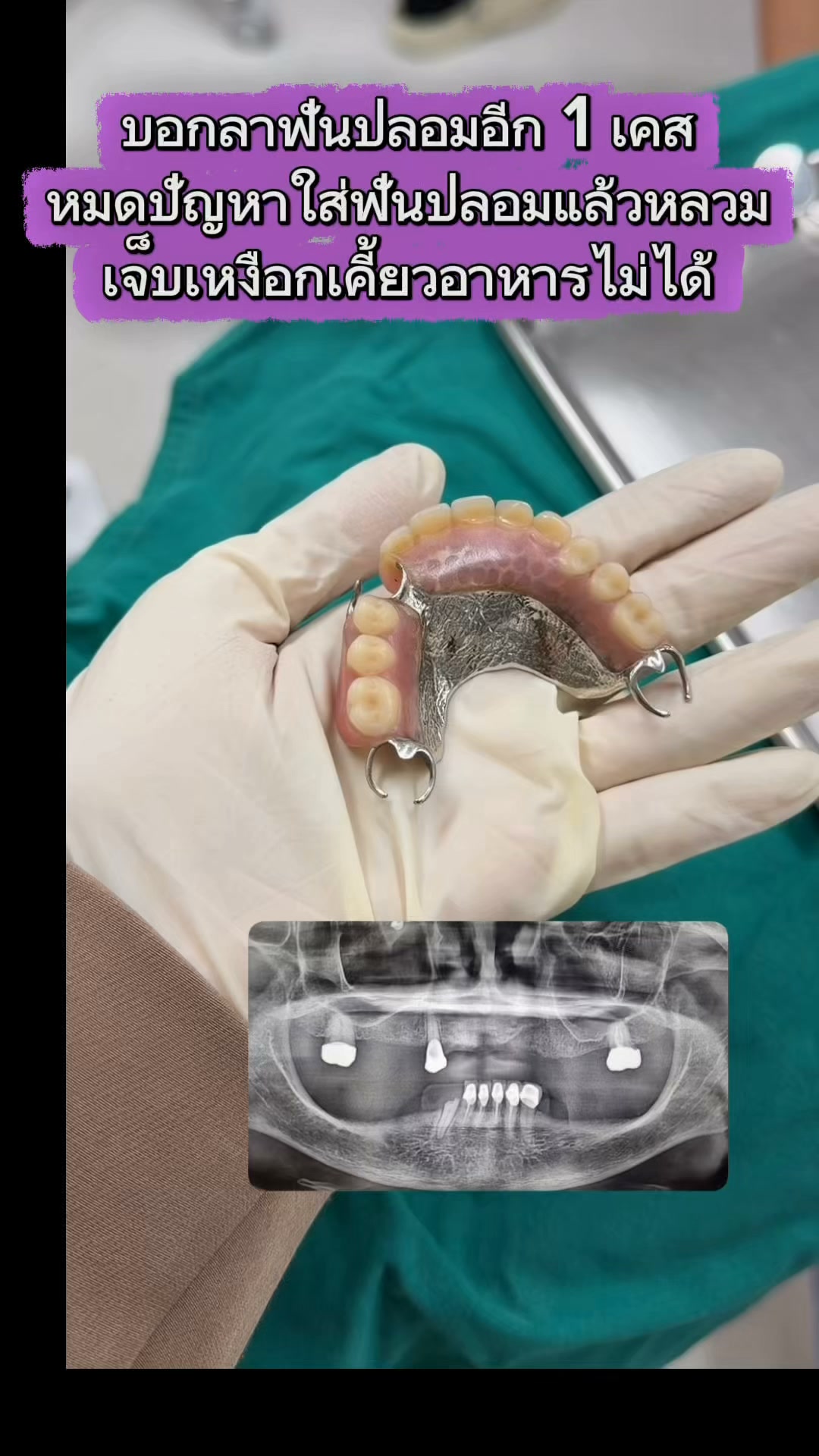 Witcha Dental Clinic ศูนย์รากฟันเทียมทั้งปากตากสิน20 Facebook ad: อยากเลิกใส่ฟันปลอม?