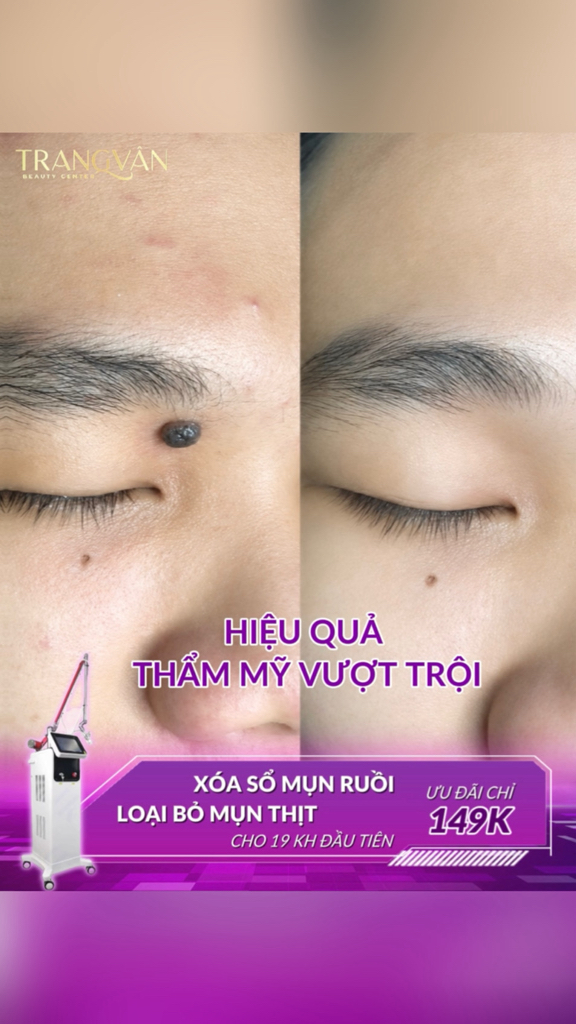 TMV Trang Vân - Beauty Center Facebook ad: XÓA SẠCH MỤN RUỒI, MỤN THỊT CÙNG LASER…