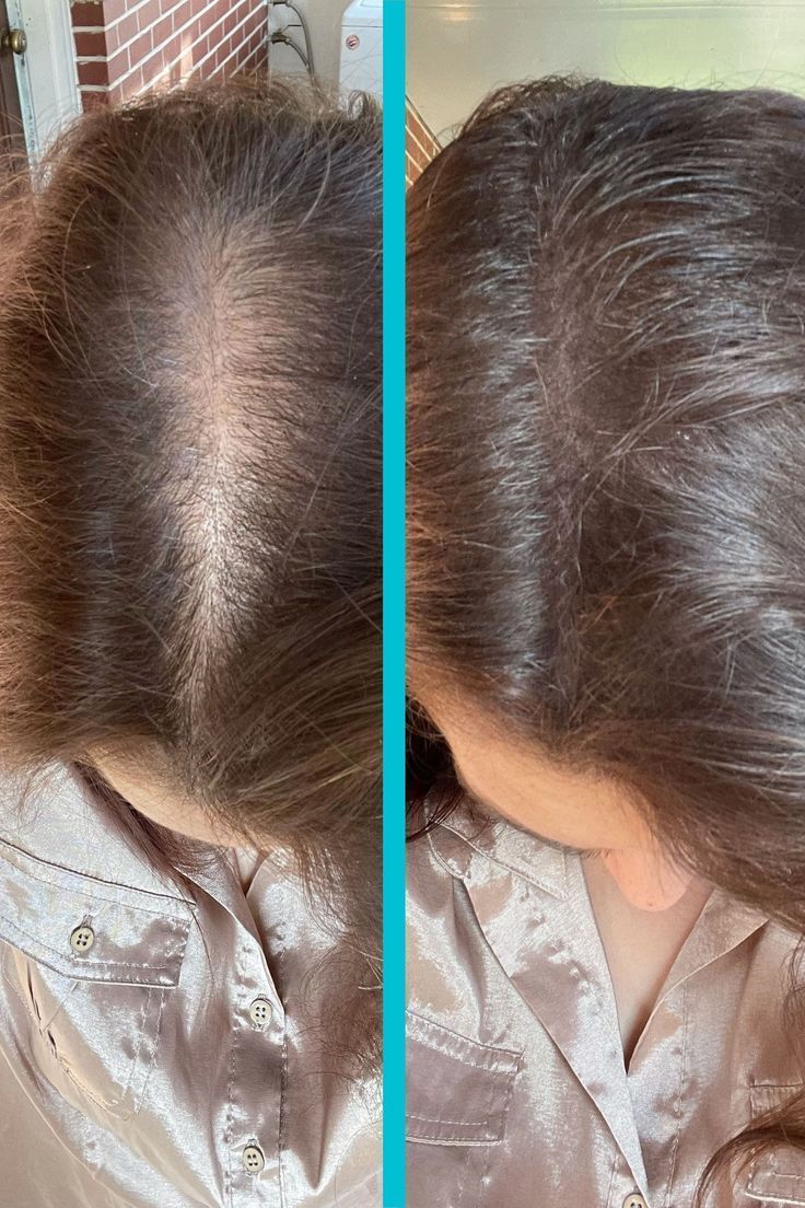 Jennifer Nelson Facebook ad: Reverse GLP-1 Hair Loss