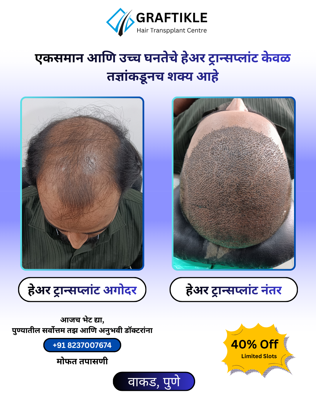 Graftikle Hair Transplant Center Facebook ad