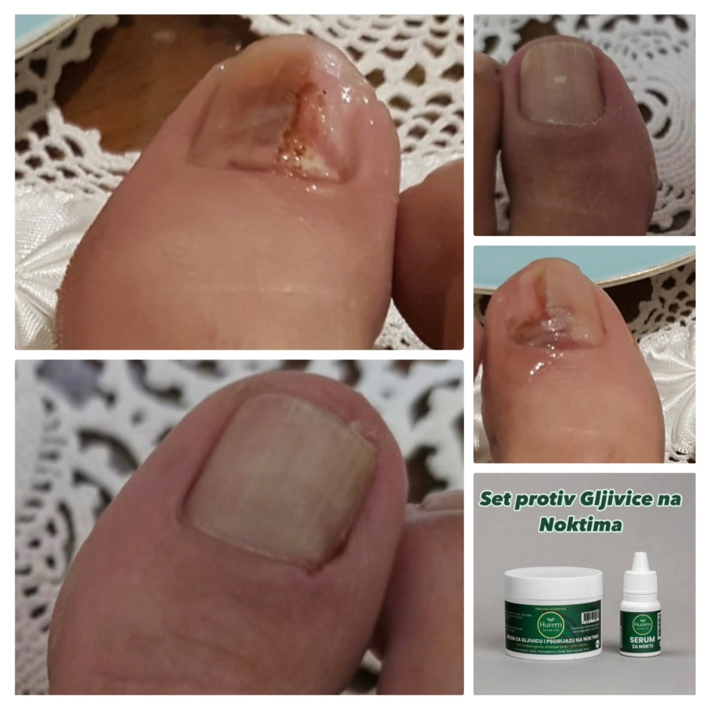 Hurem melem lek - Crna Gora Facebook ad: Gljivice na noktima, poznate i kao onihomikoza, su…