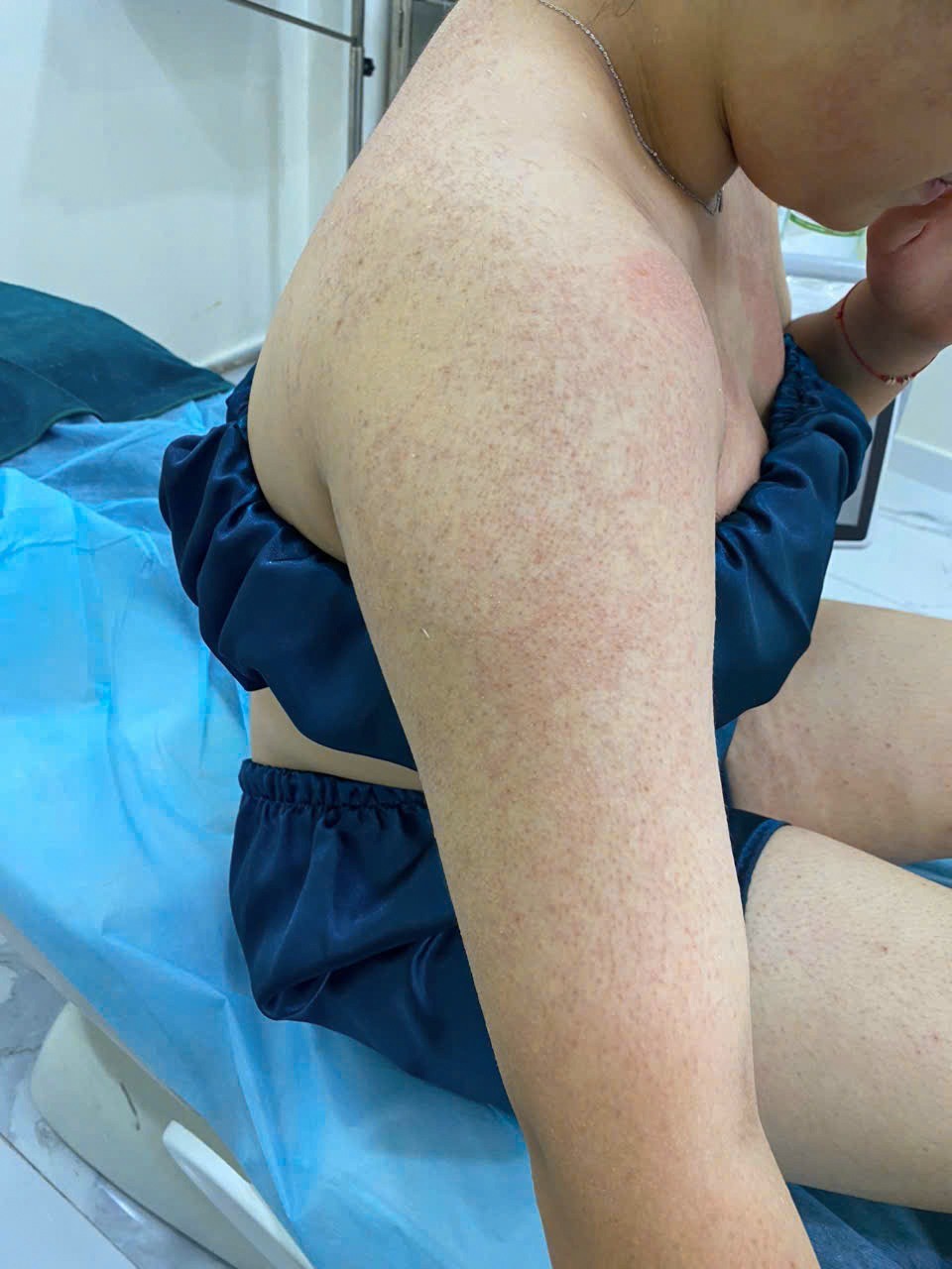 Phytocare Derma Clinic - Makati Facebook ad: [Case 352, Folliculitis Treatment on the Back &…