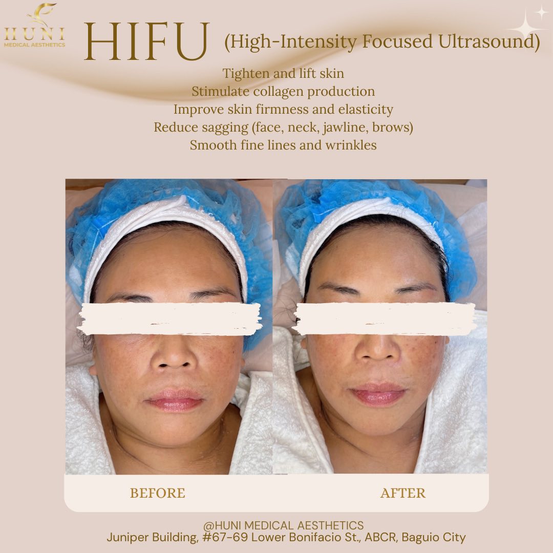 Huni Medical Aesthetics Facebook ad: Subtle enhancements, visible results.