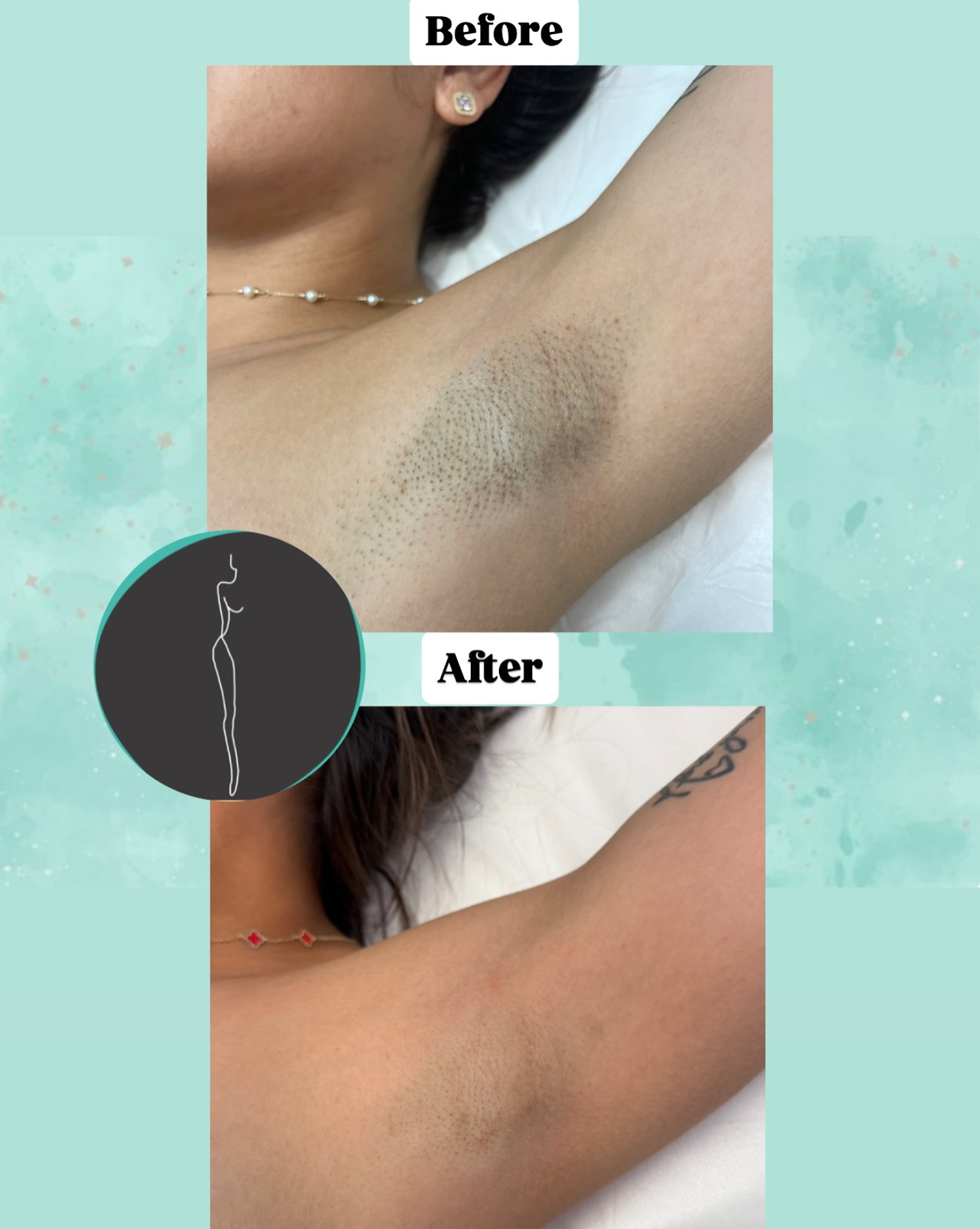 JH Laser Hair Removal Facebook ad