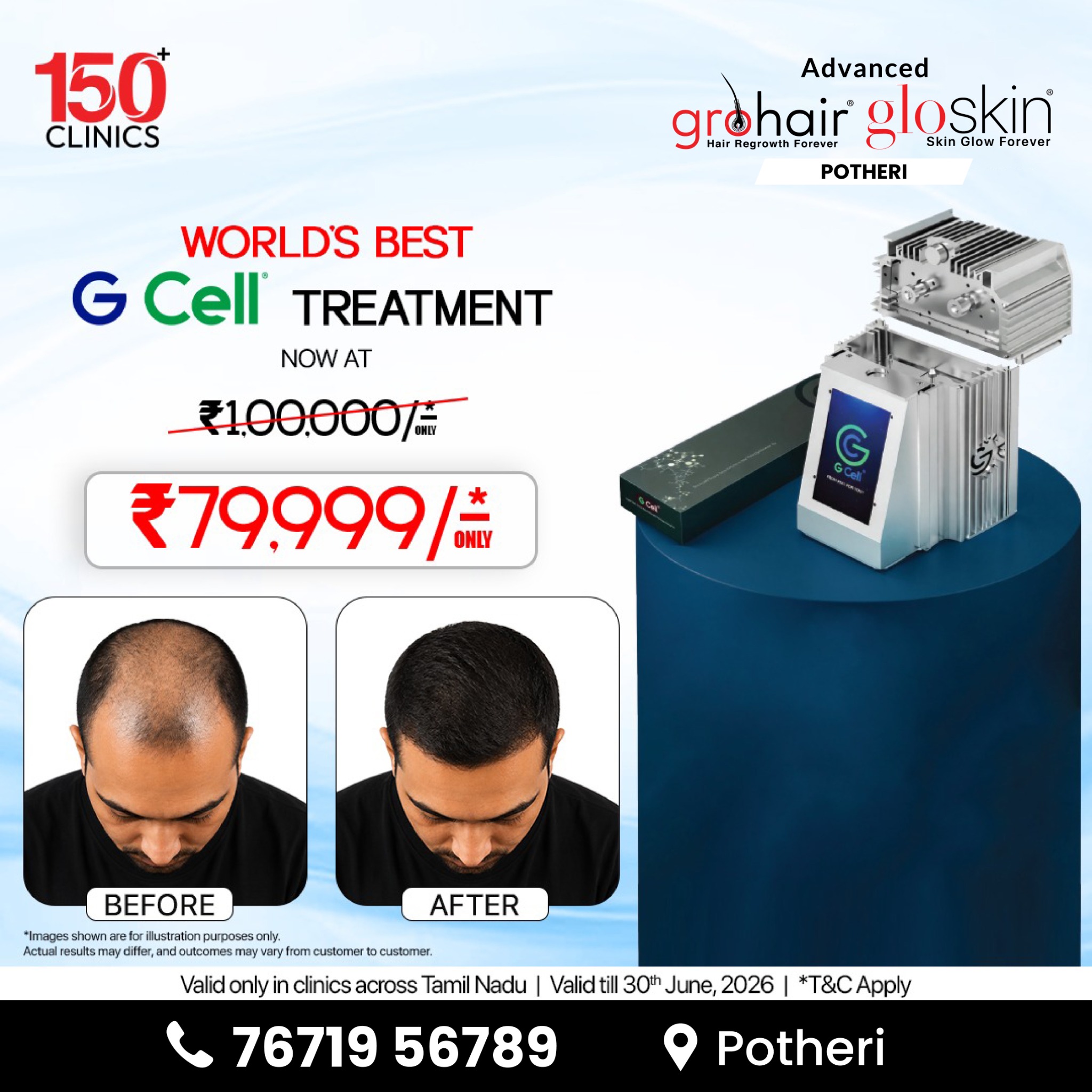 Advanced Grohair & Gloskin Clinic Potheri Facebook ad: G Cell Treatment ippove just ₹79,999/- only!