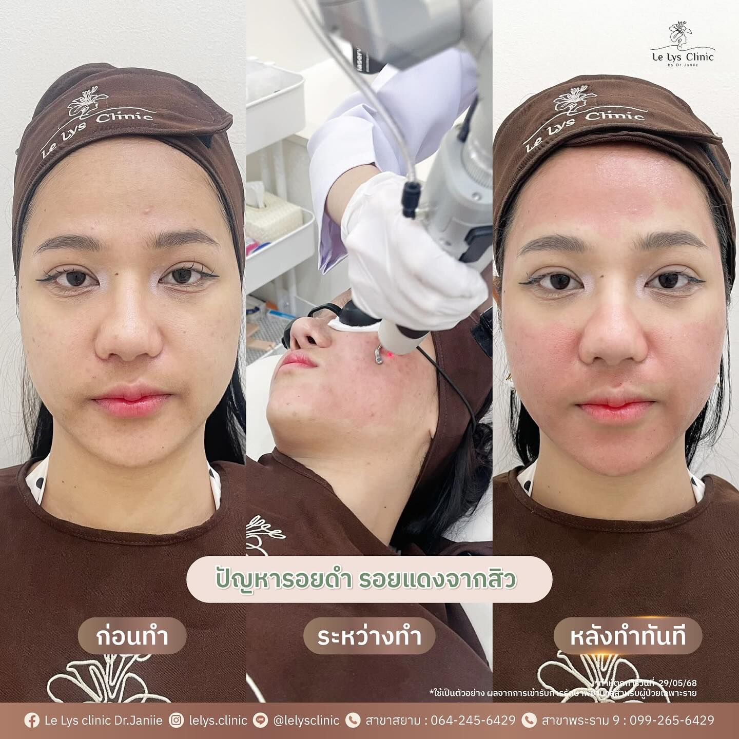 Le Lys clinic by Dr.Janiie เลอลิส คลินิก Facebook ad: ปรับผิวใส ดูแลฝ้า กระ รอยสิว…