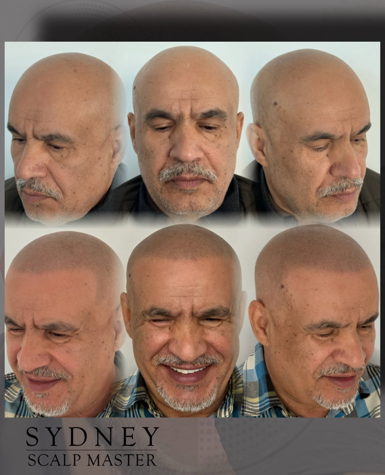 Sydney Scalp Master Facebook ad: A Super Realistic SMP Treatment in Sydney