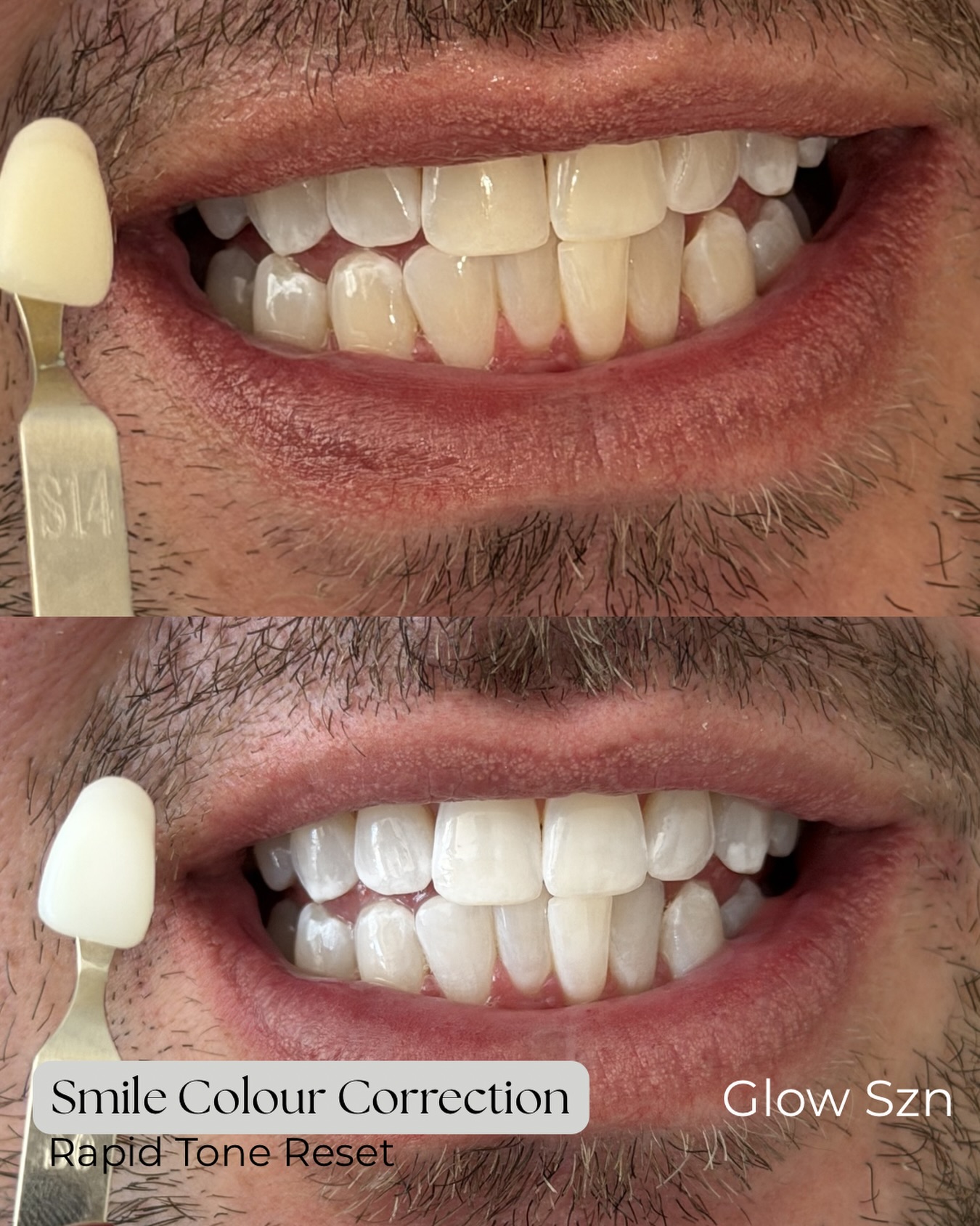 Glow SZN Facebook ad: Brighter Looking Teeth in One Appointment $250