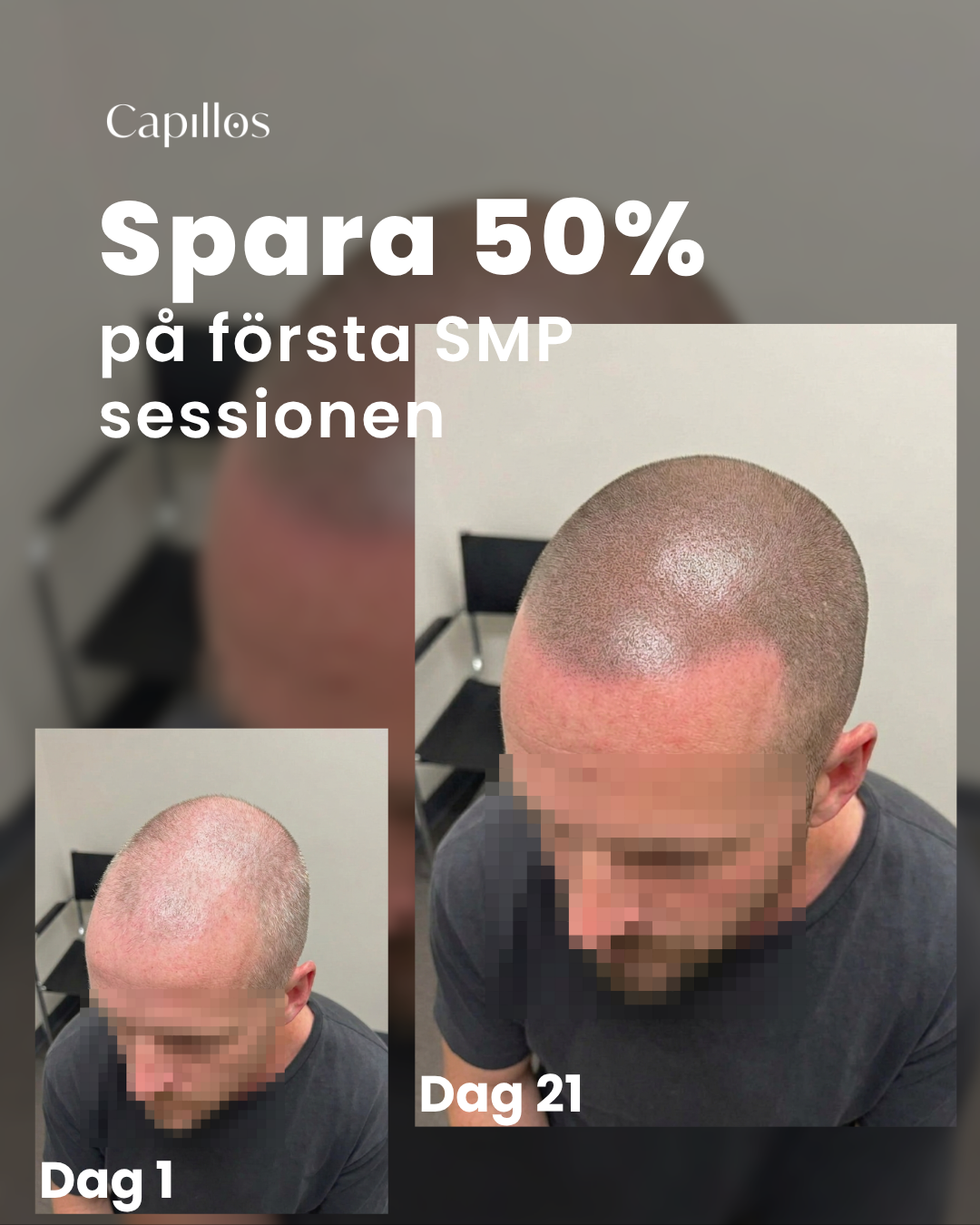 Scalp Micropigmentation Capillos Facebook ad from May 13, 2026