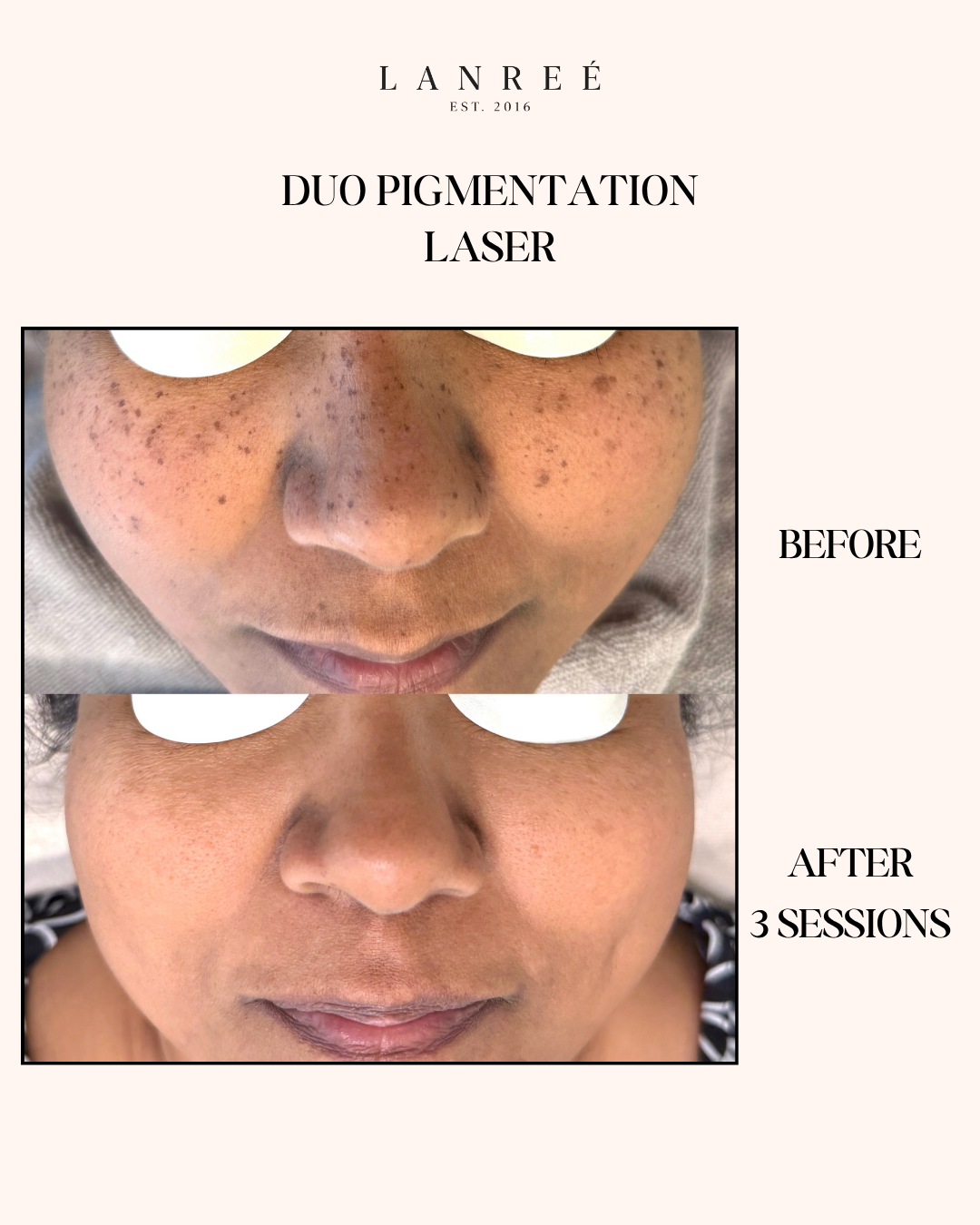 Lanree Aesthetics Facebook ad from Jul 20, 2026
