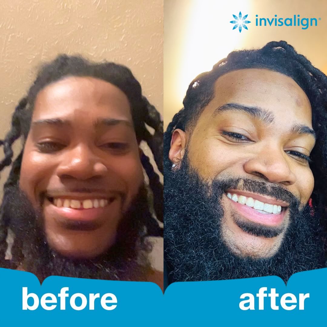 Invisalign Facebook ad