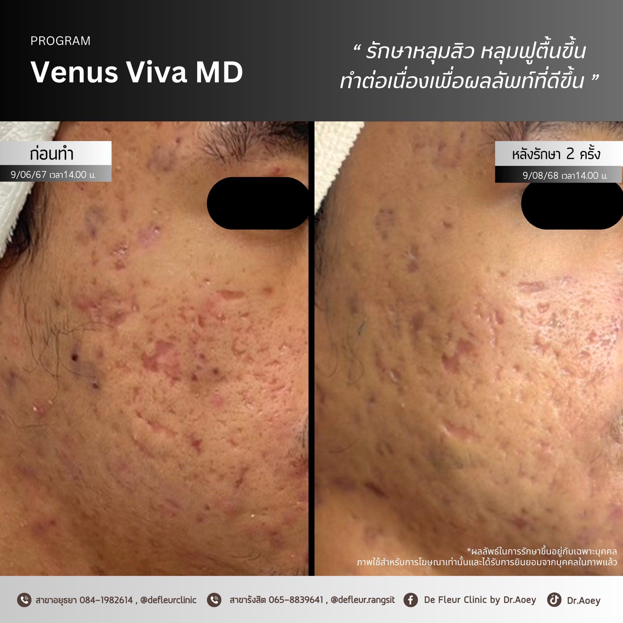 De Fleur Clinic by Dr.Aoey เดอเฟลอร์คลินิกความงามสาขาอยุธยา Facebook ad: หลุมสิวเล็กน้อย แต่บั่นทอนความมั่นใจไม่น้อยเลย…