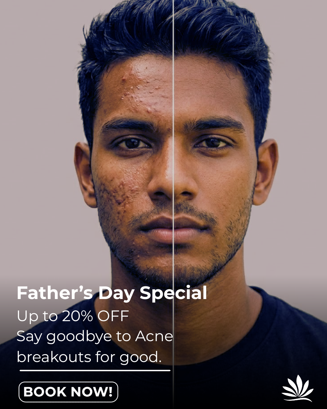 Prana Skin & Laser Clinic Facebook ad: Up to 20% OFF -Acne treatments