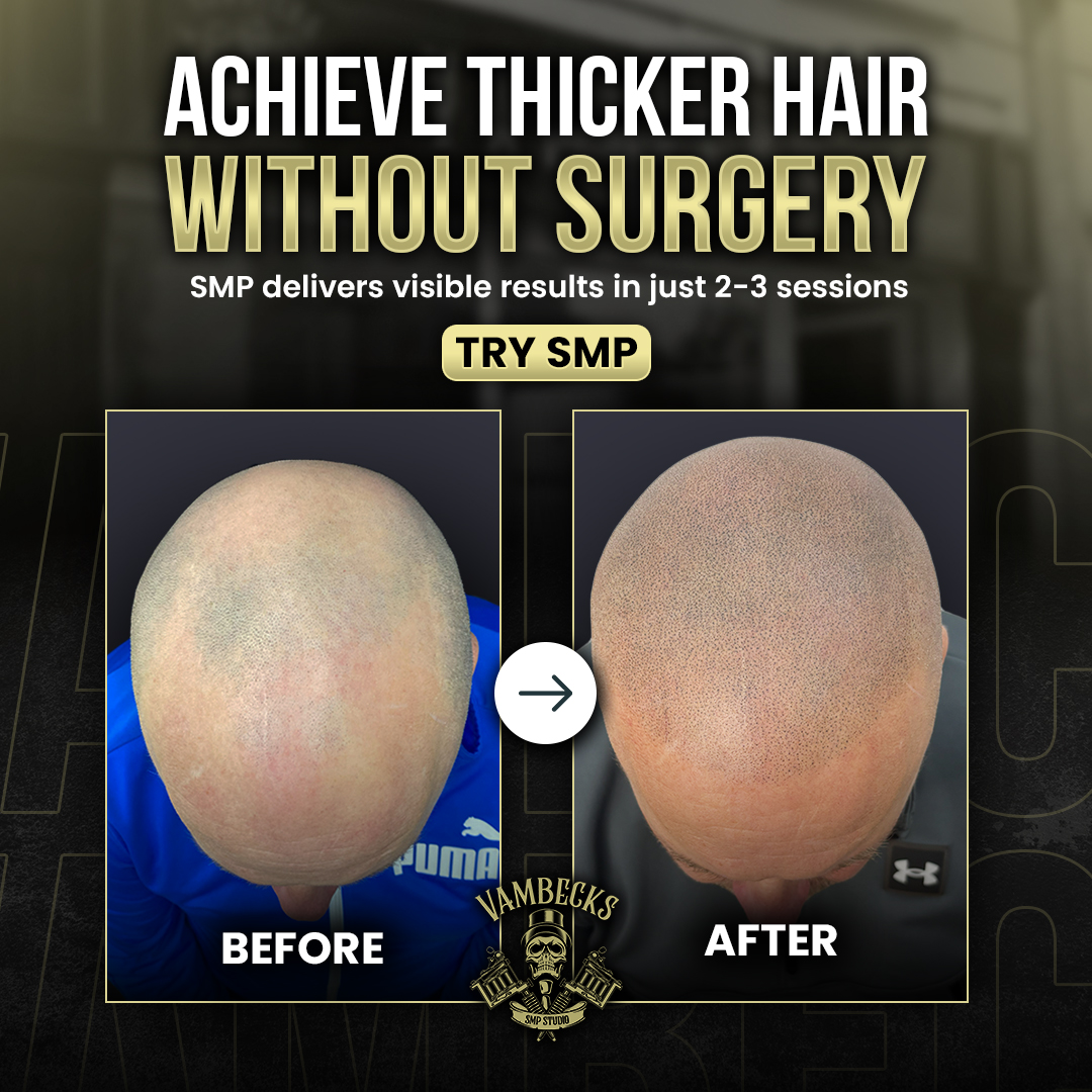 Vambecks SMP Facebook ad: Donegal, 15% Off Scalp Micropigmentation