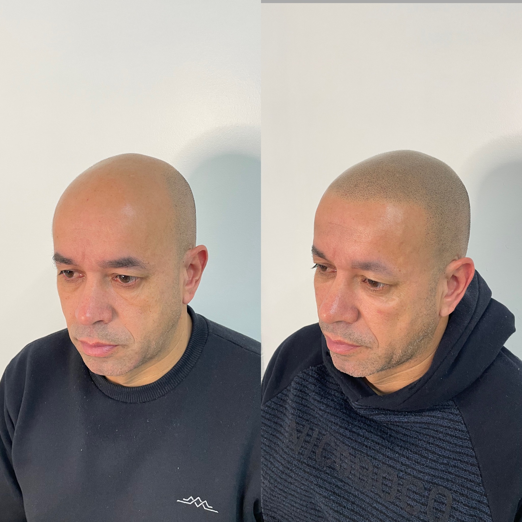 Henrique Paim micro capilar Facebook ad: A calvície não precisa mais te incomodar.