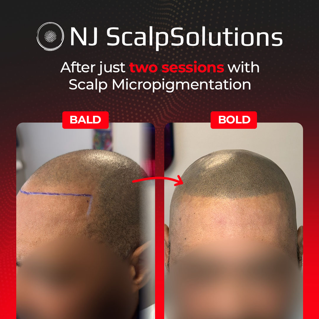 NJ ScalpSolutions Facebook ad: New Jersey, 15% Off Scalp Micropigmentation