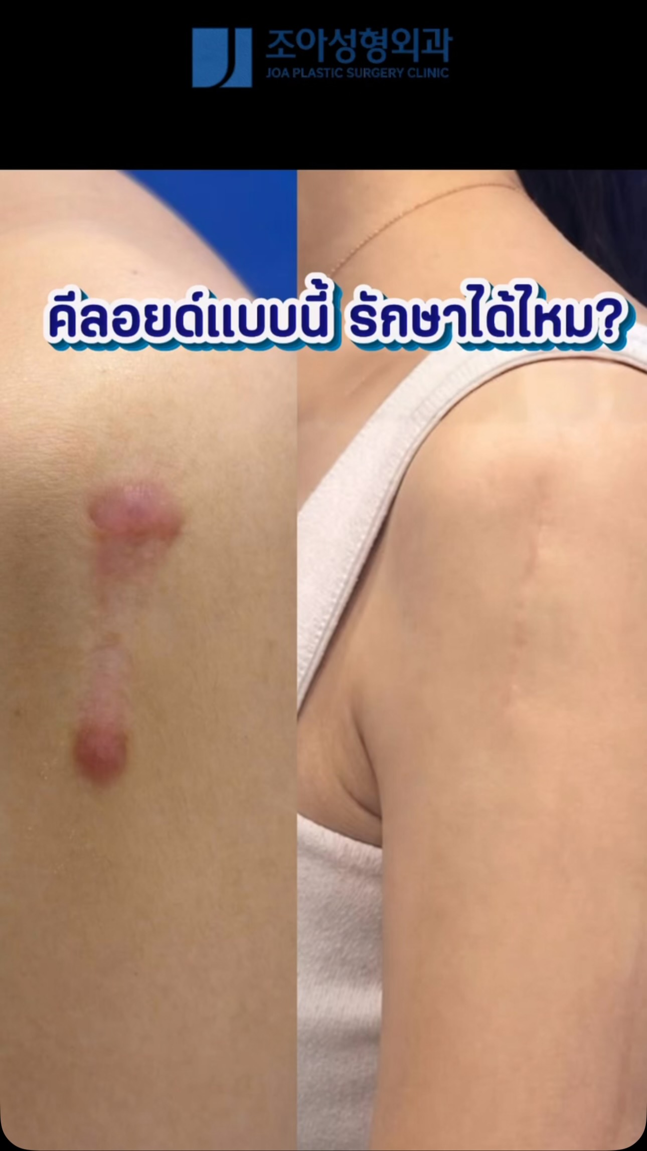 โรงพยาบาลโจอาเกาหลี ศูนย์เลเซอร์แผลเป็นมาตรฐานสากล โดยแพทย์เฉพาะทาง Facebook ad: แผลเป็นนูน ไม่ได้แปลว่าต้องอยู่กับมันตลอดไป