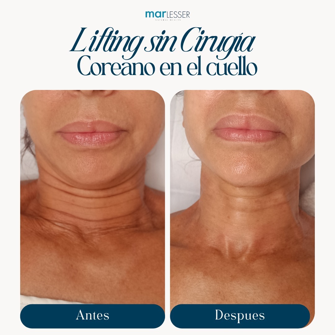 Mar Lesser Salud y Belleza Facebook ad: ¡Transformación asombrosa con nuestro Lifting Facial…