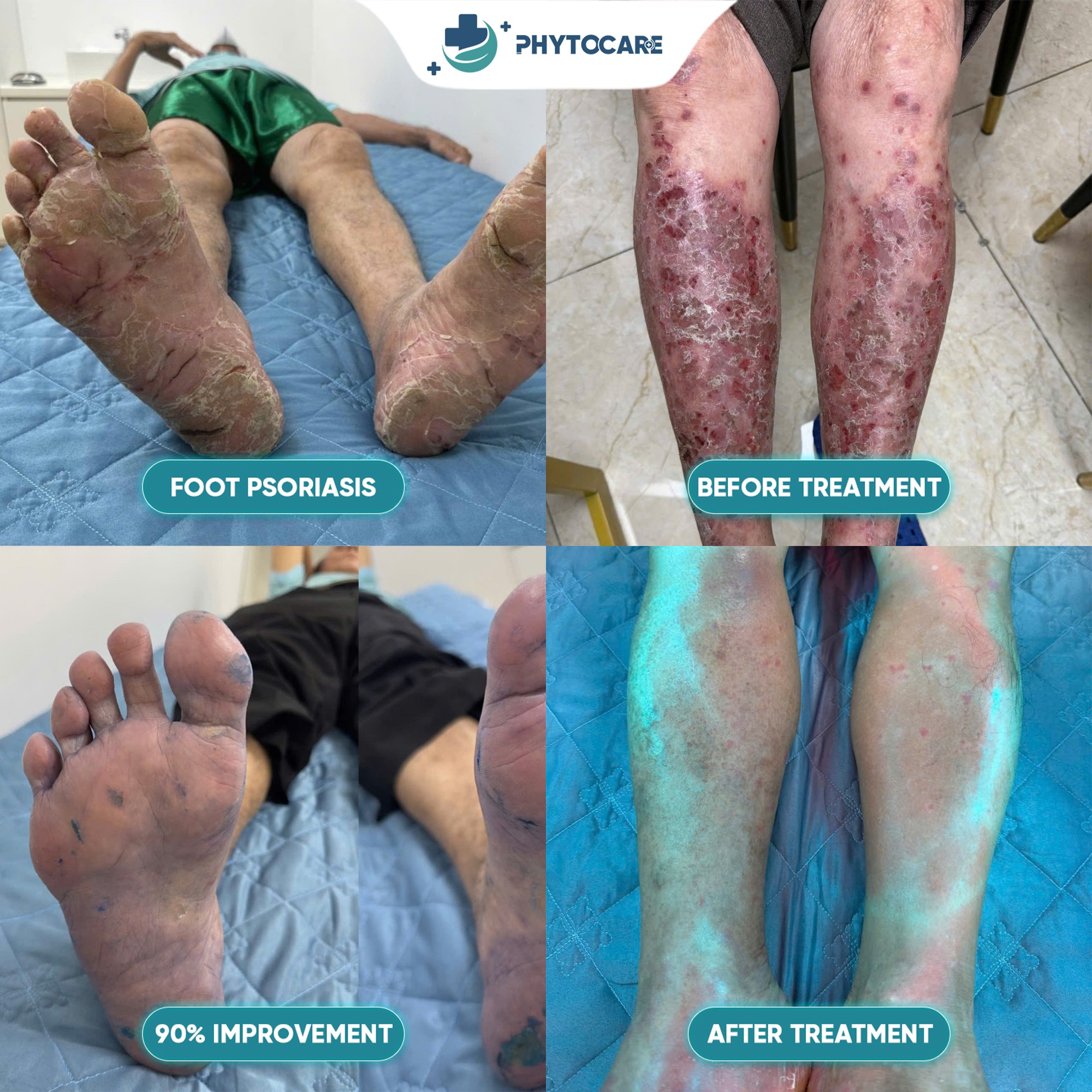 Phytocare Derma Clinic Davao Facebook ad: GOODBYE PSORIASIS PAIN.