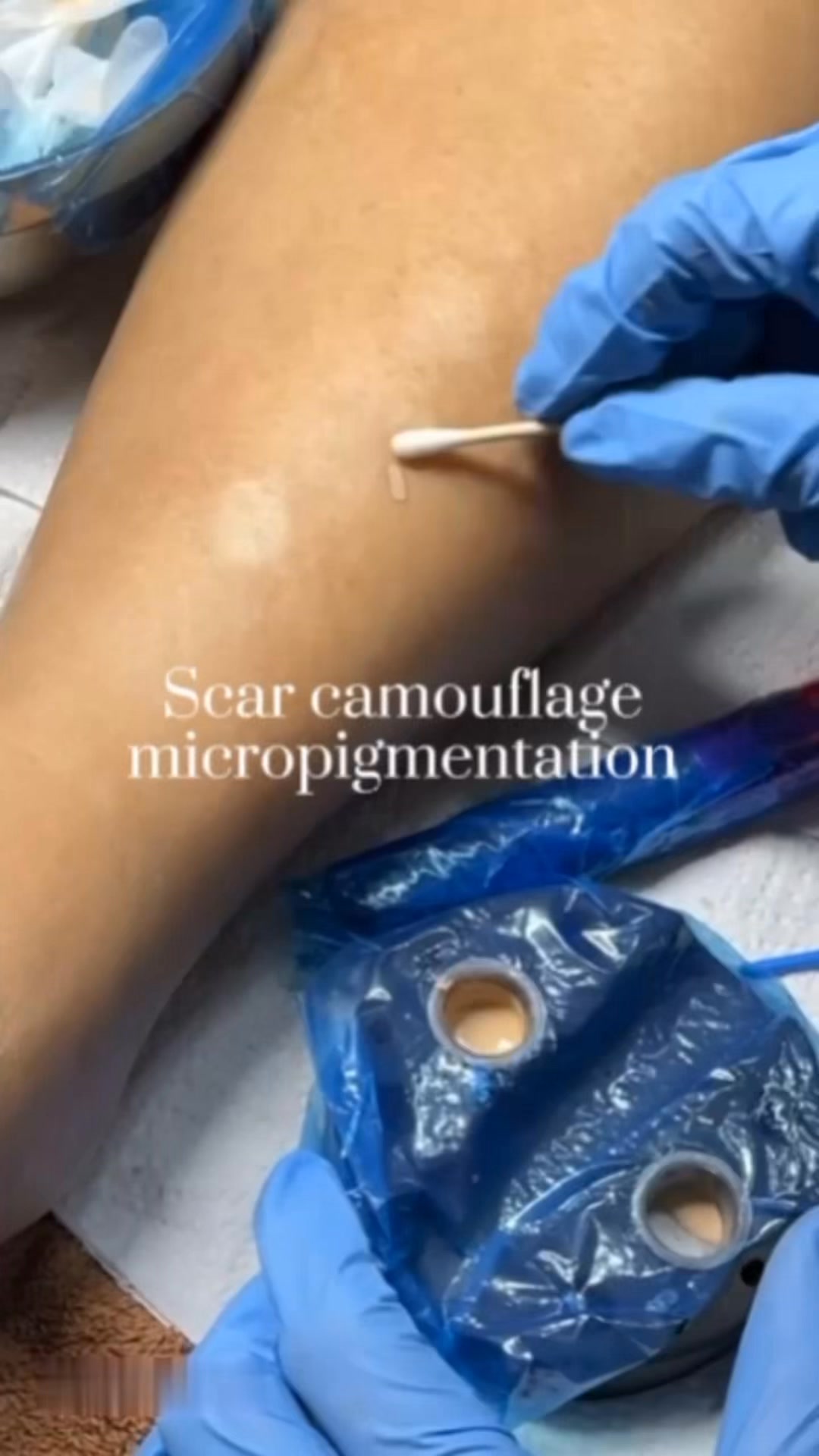 Skintone Camouflage PH Facebook ad: What is Scar Camouflage Micro-pigmentation?
