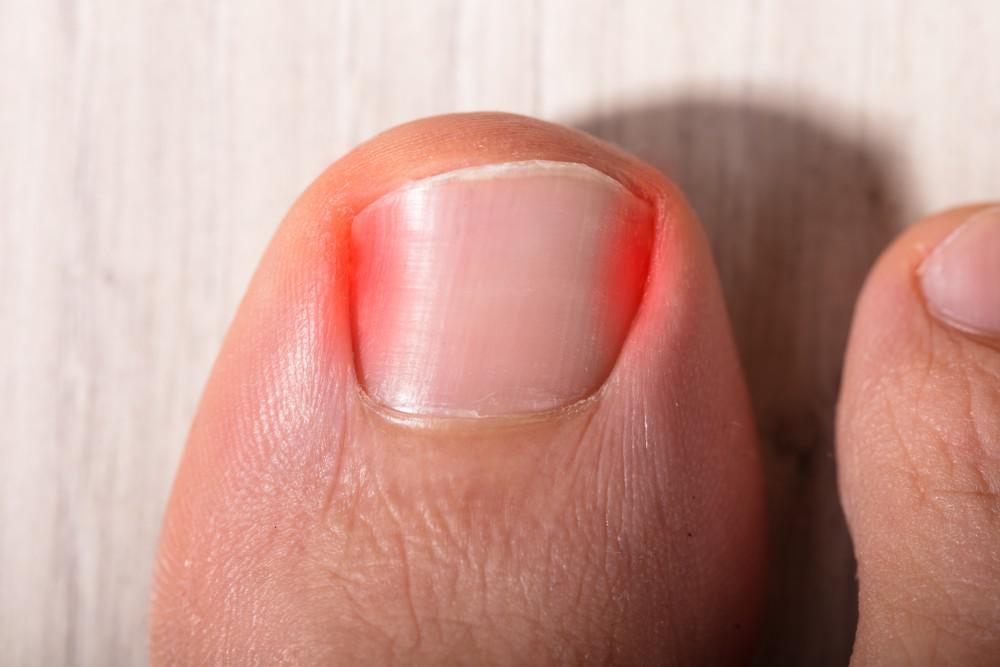 Ingrown Toenail Care, Canberra Facebook ad: Sore Ingrown Toenails?