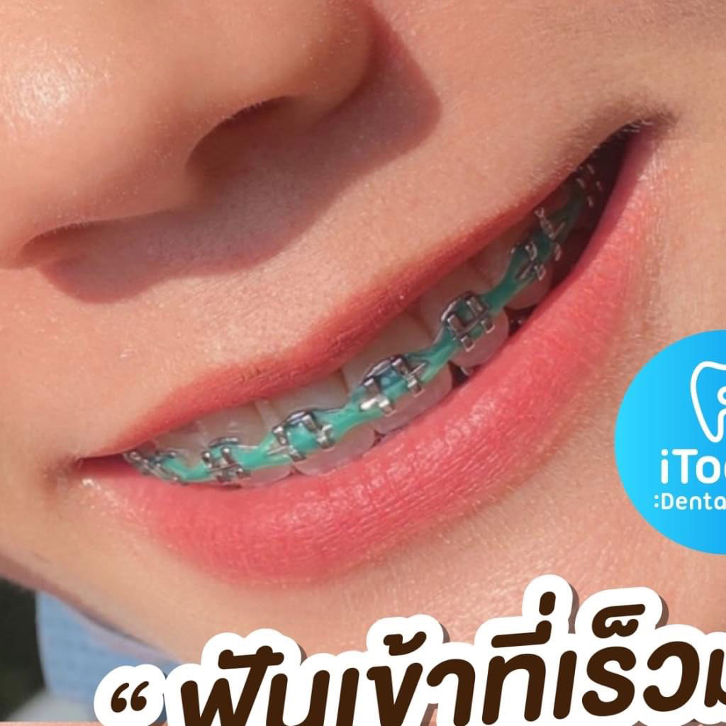 Itooth Dental Clinic ทันตกรรม ขอนแก่น Facebook ad