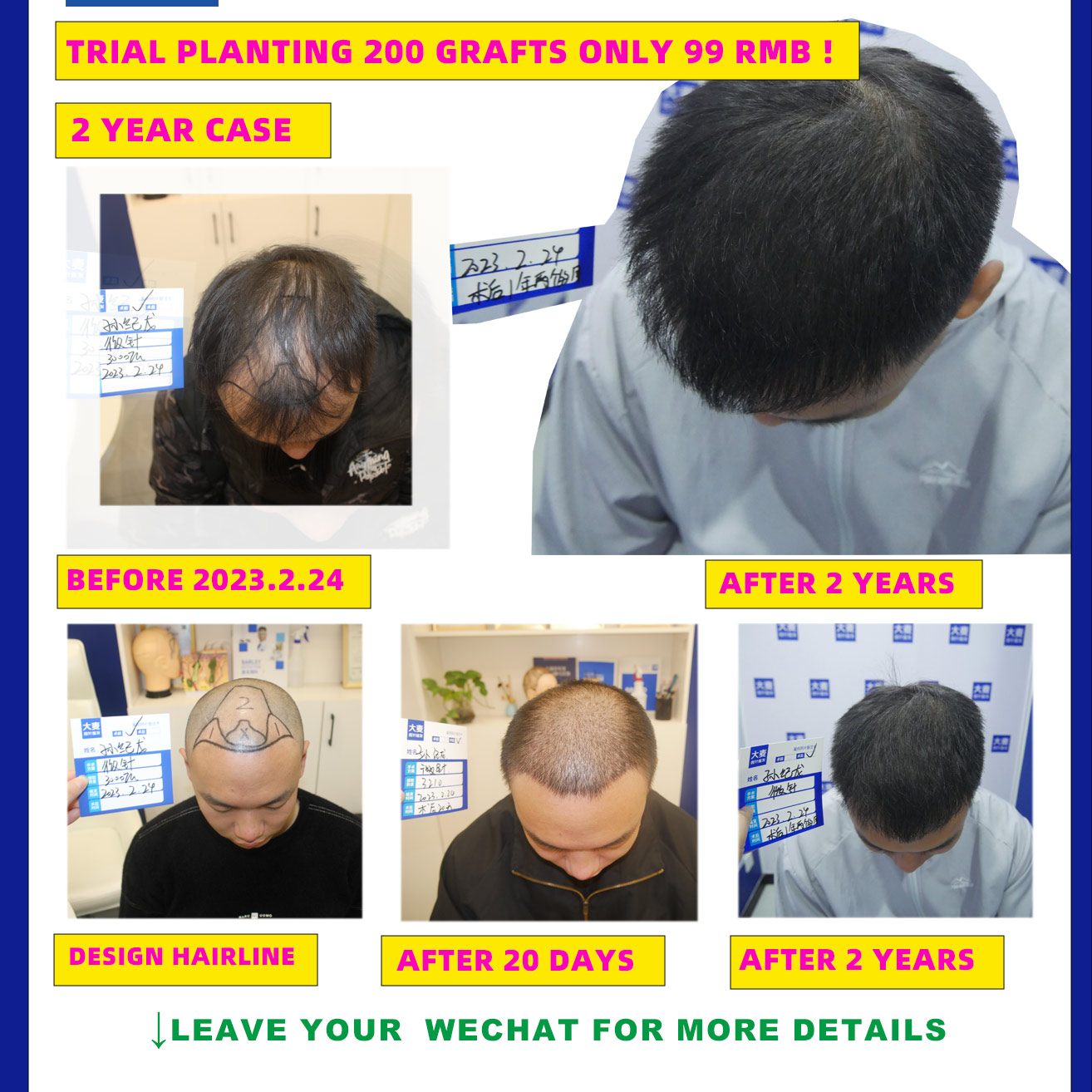 Barley Hair Transplant Facebook ad