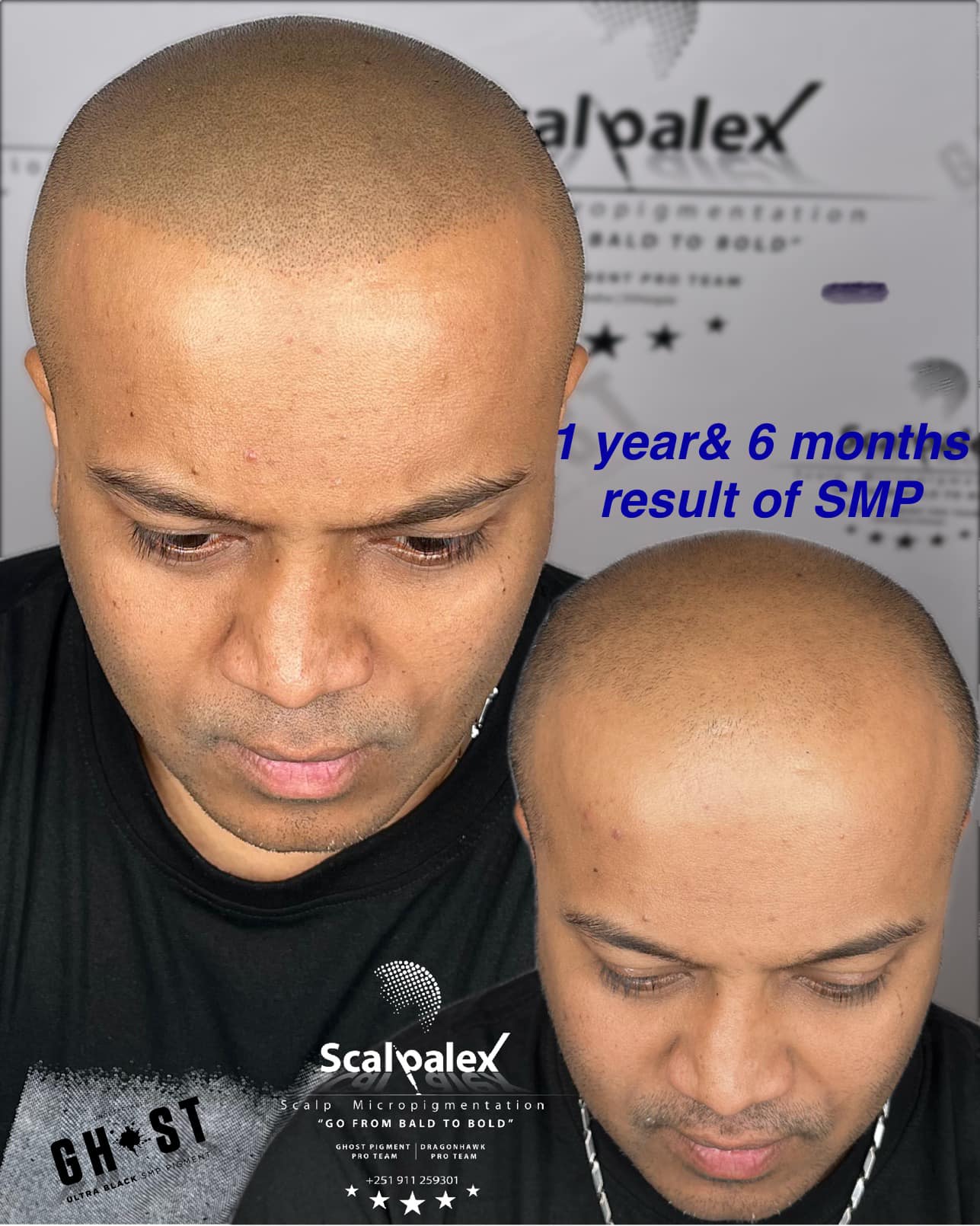 Scalpalex Scalp Micropigmentation Facebook ad: የረቀቀ የፀጉር ታቱ(Scalp Micropigmentation)